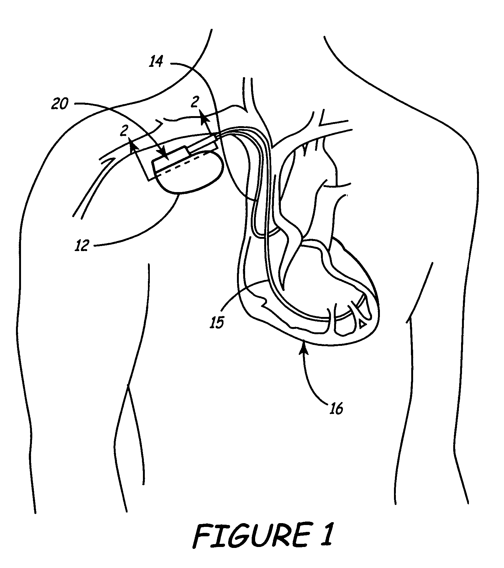Method and apparatus for automatic implantable medical lead recognition and configuration