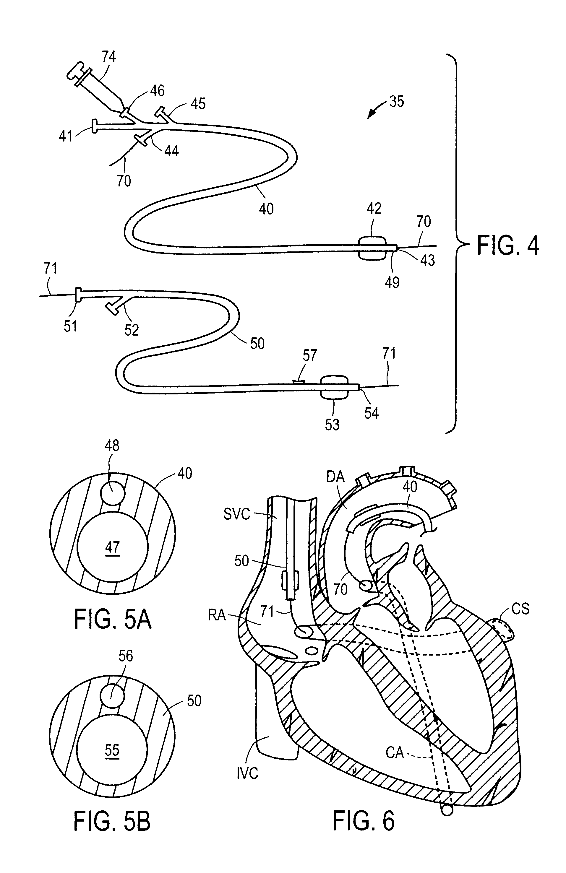 Methods and apparatus for treating infarcted regions of tissue following acute myocardial infarction