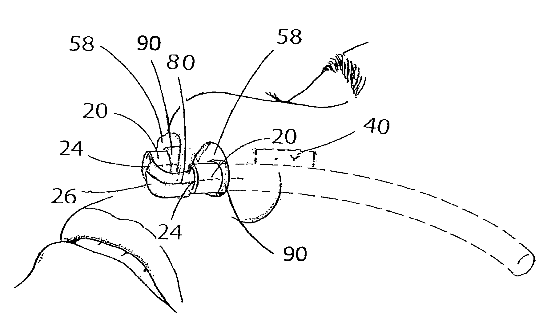 Device and Method for Maintaining Unobstructed Nasal Passageways after Nasal Surgery