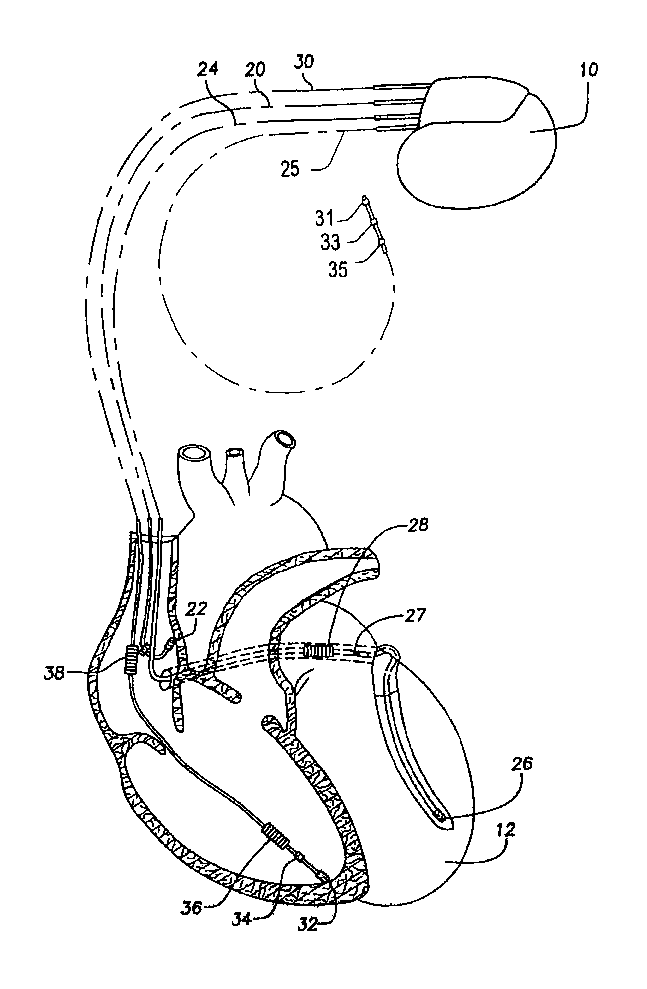 Systems and methods for detecting alternans in intrinsic rhythms to monitor myocardial stability