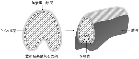 Preparation, product and application of sandwich type degradable stent for alveolar bone repair