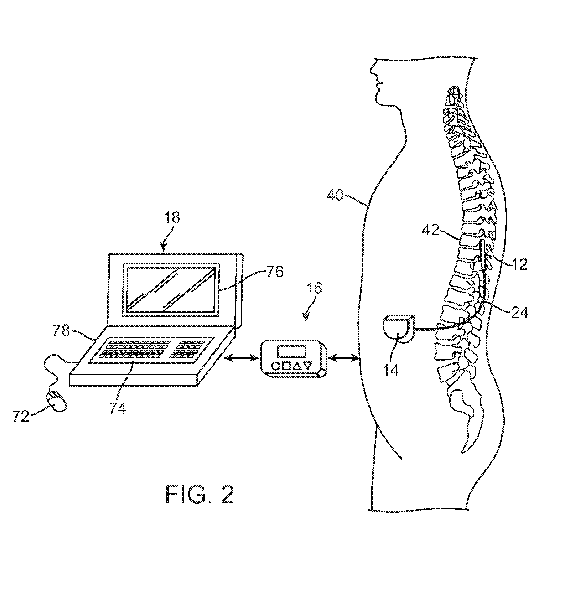 Neurostimulation system with flexible patterning and waveforms