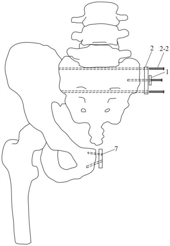 Assembled universal osseointegration semi-pelvic prosthesis