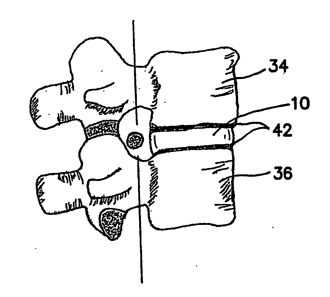 Artificial nucleus pulposus and method of injecting same