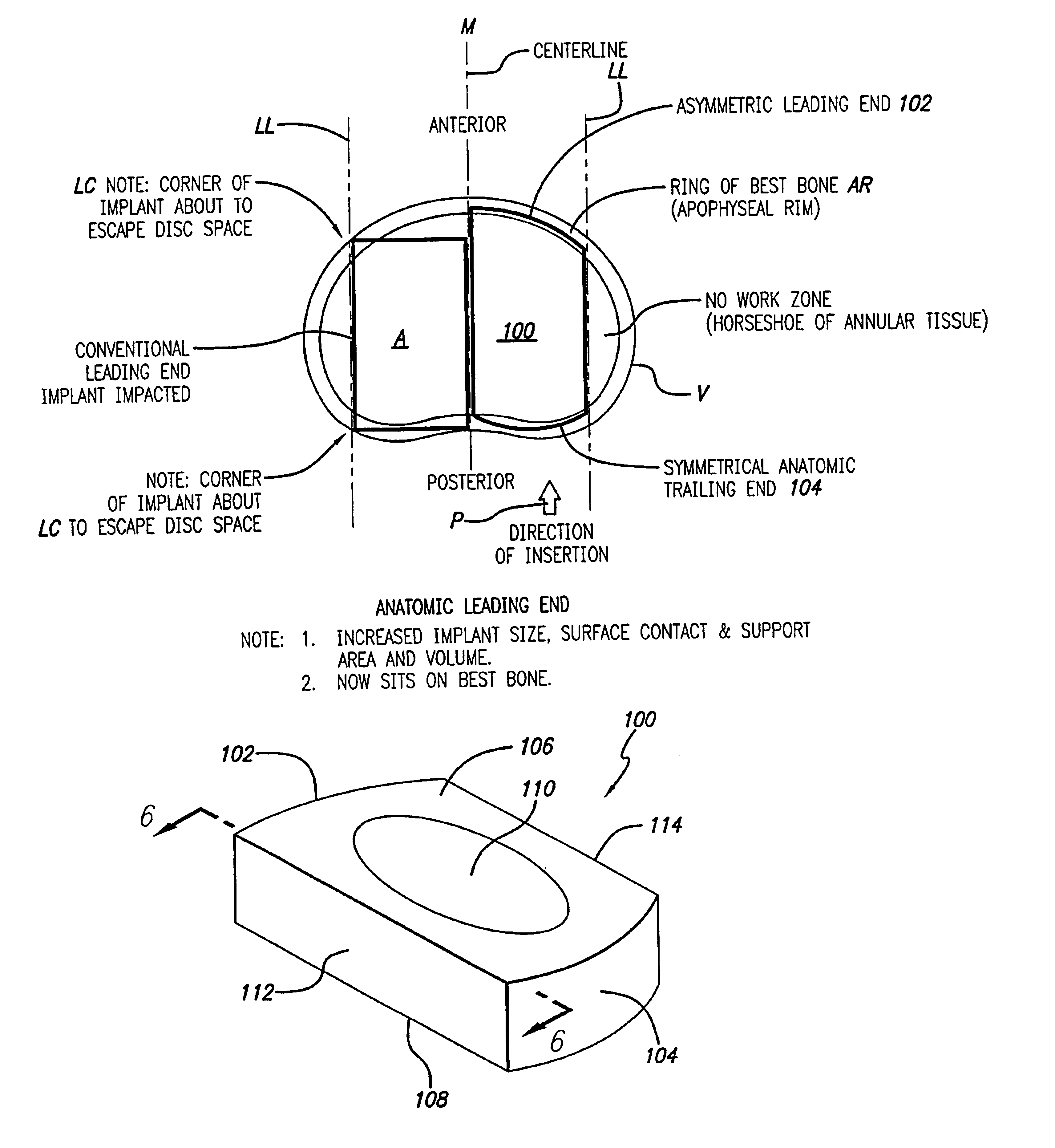 Bone hemi-lumbar interbody spinal fusion implant having an asymmetrical leading end and method of installation thereof