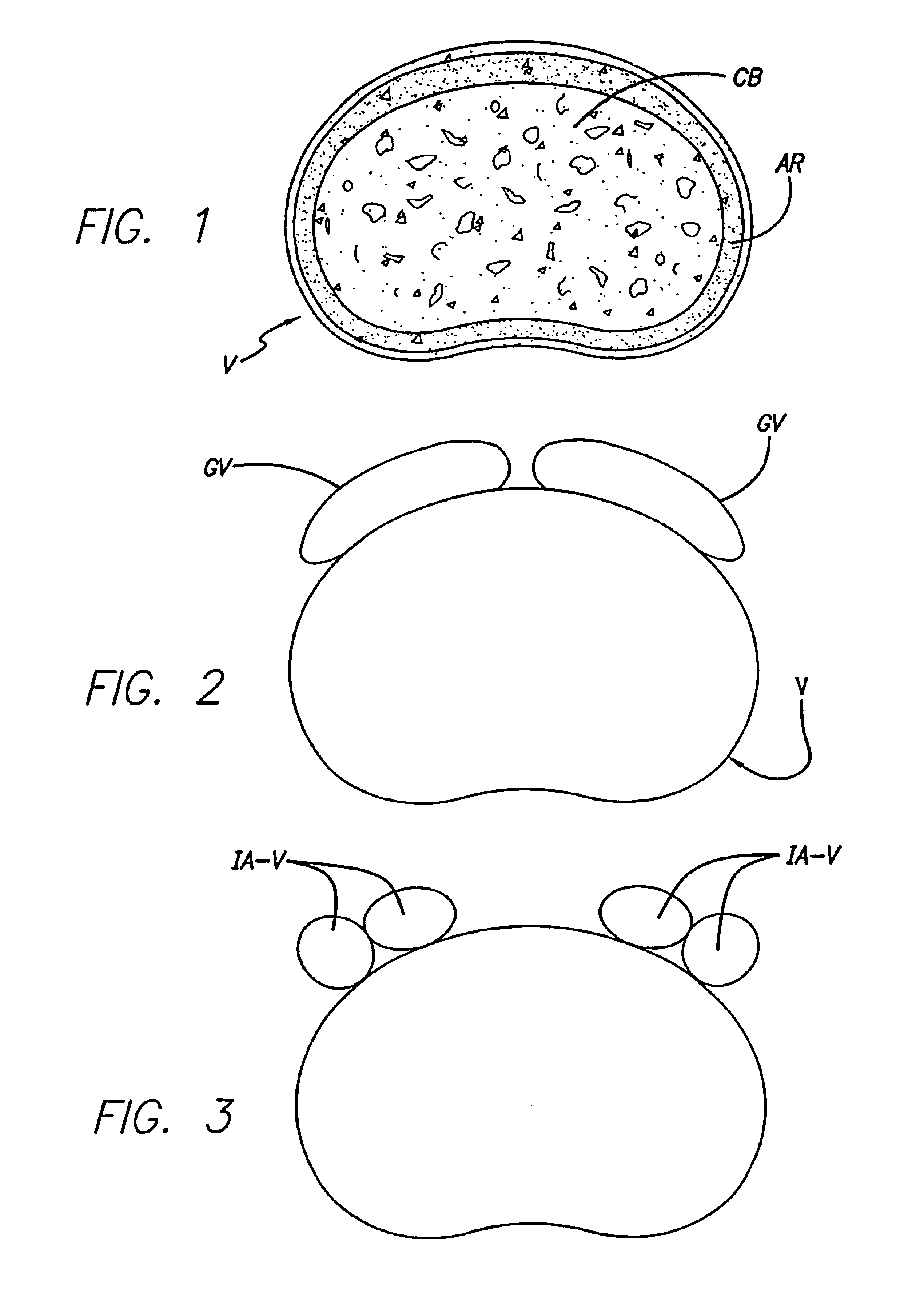 Bone hemi-lumbar interbody spinal fusion implant having an asymmetrical leading end and method of installation thereof