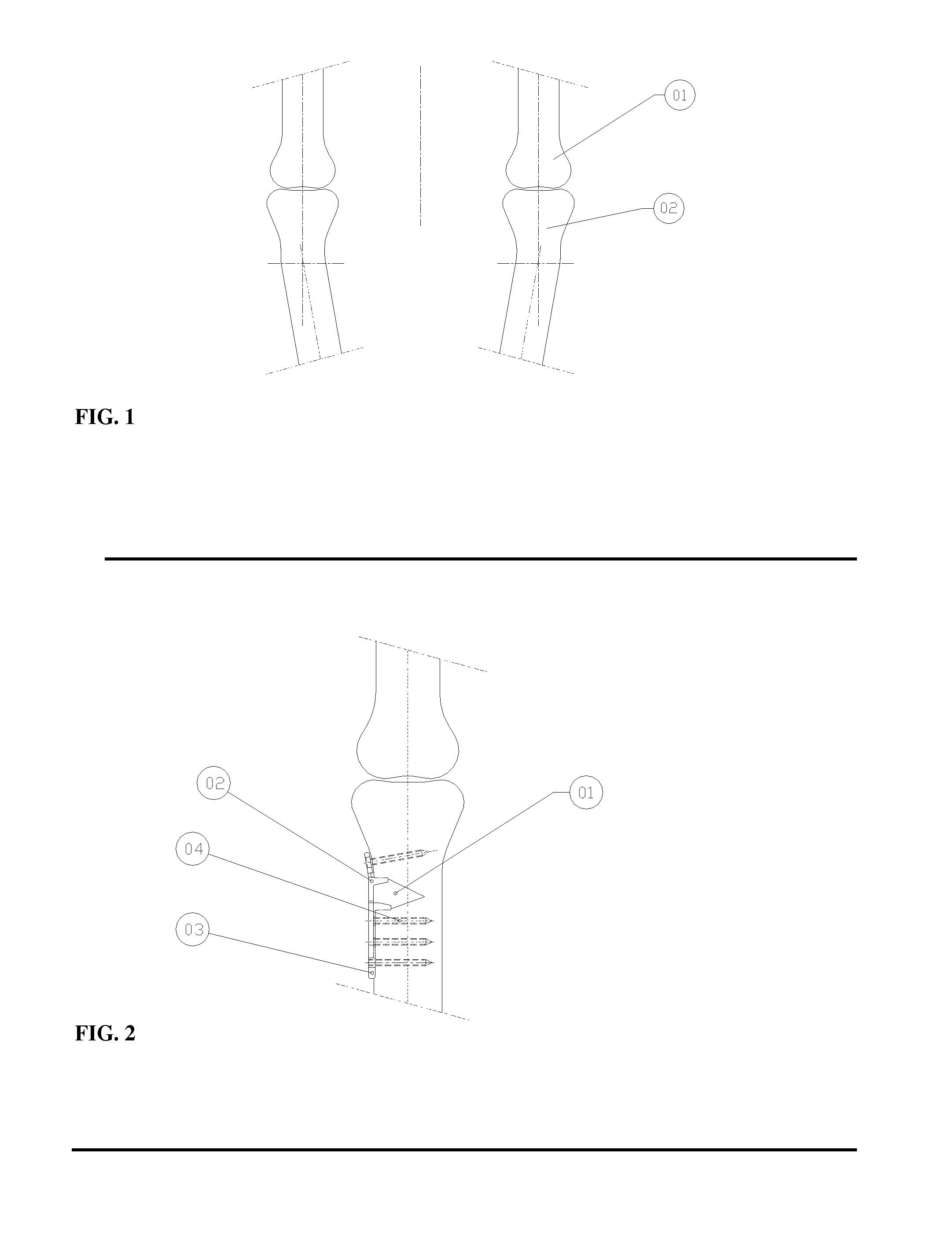 Multi-adjustable plate for osteotomy