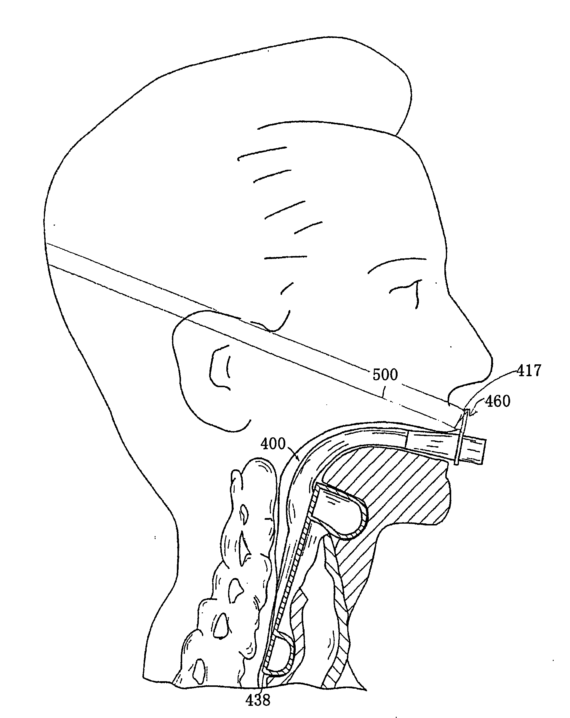 Laryngeal mask with tape tab
