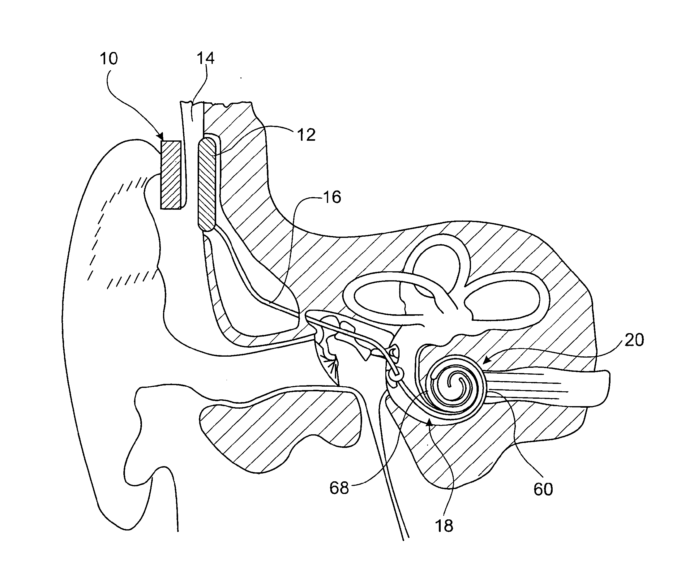 Cochlear implant hearing instrument