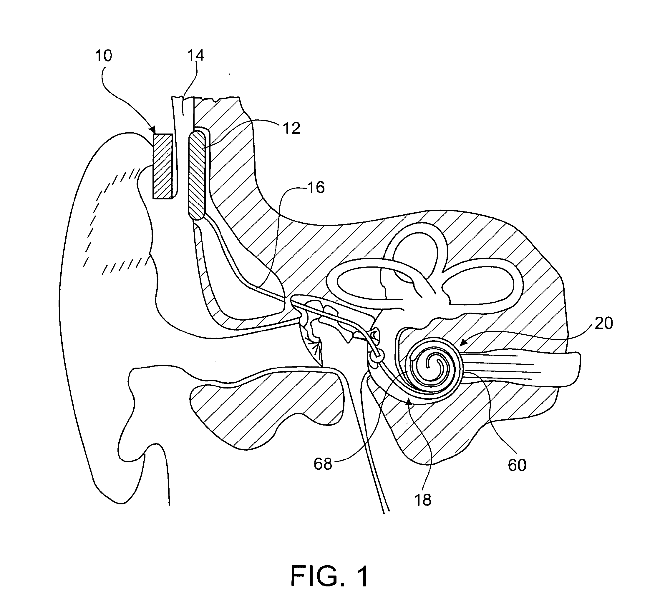 Cochlear implant hearing instrument