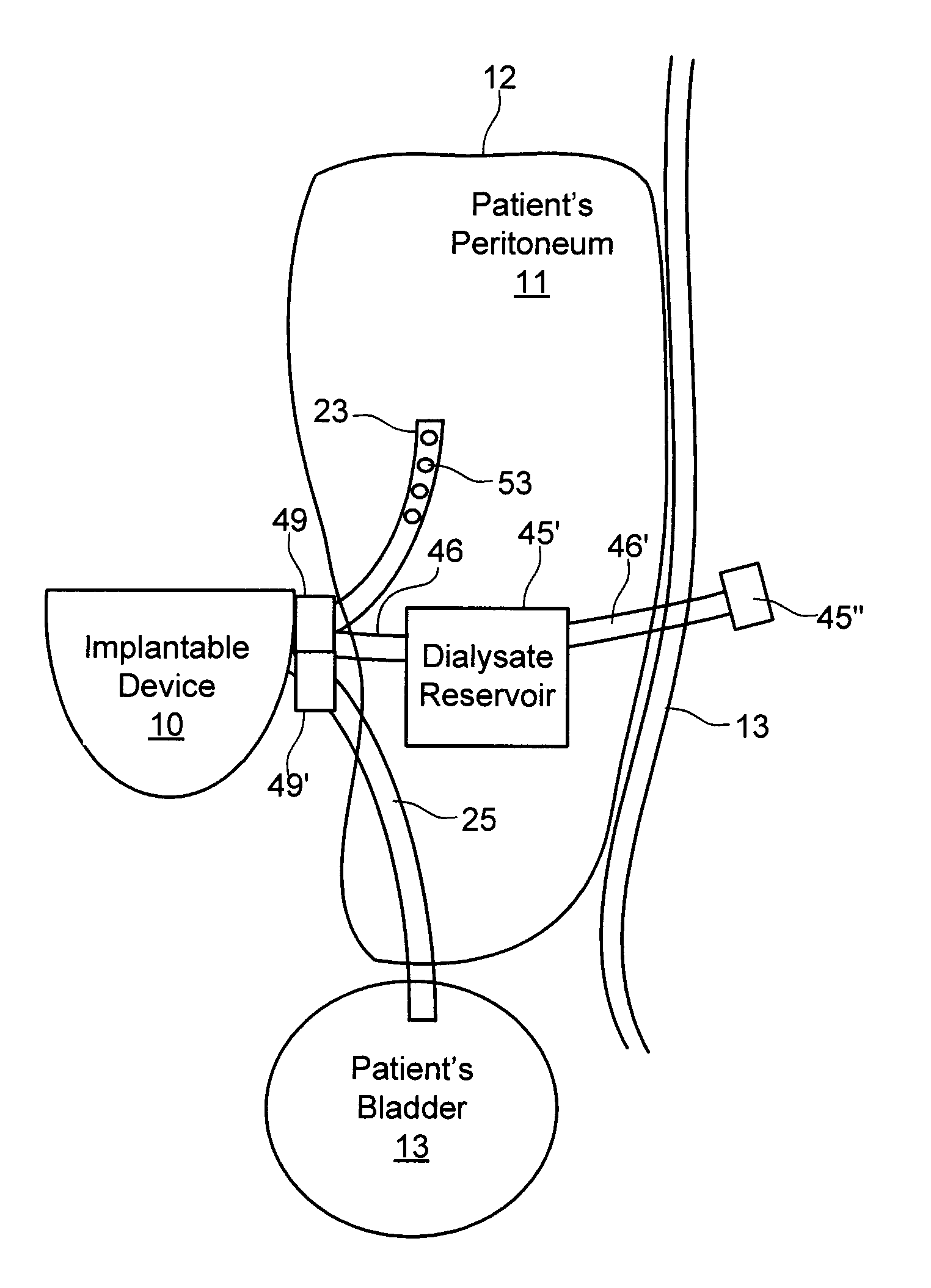 Systems and methods for treating chronic liver failure based on peritoneal dialysis
