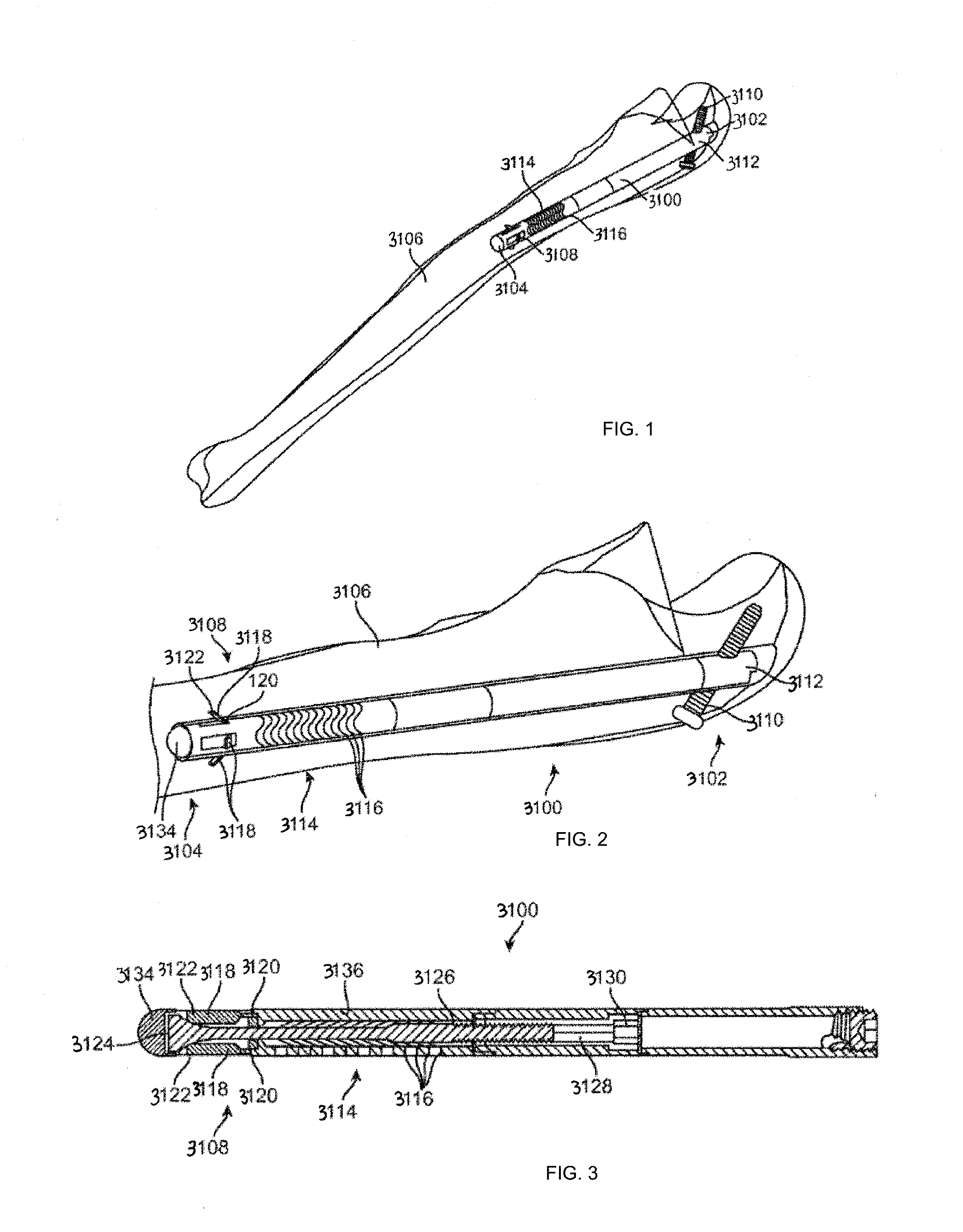 Intramedullary fracture fixation devices and methods