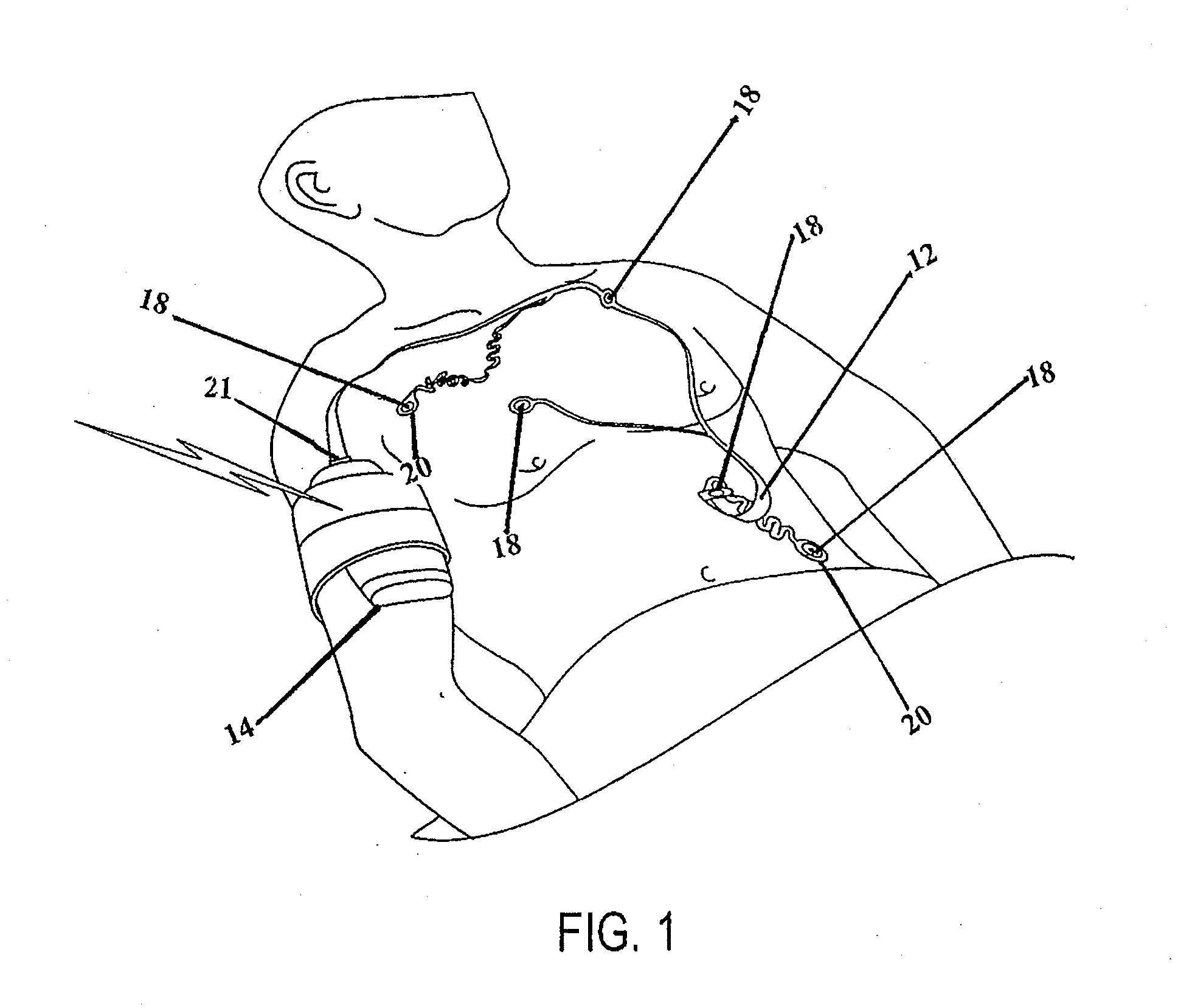 Radiolucent Electrode Assembly