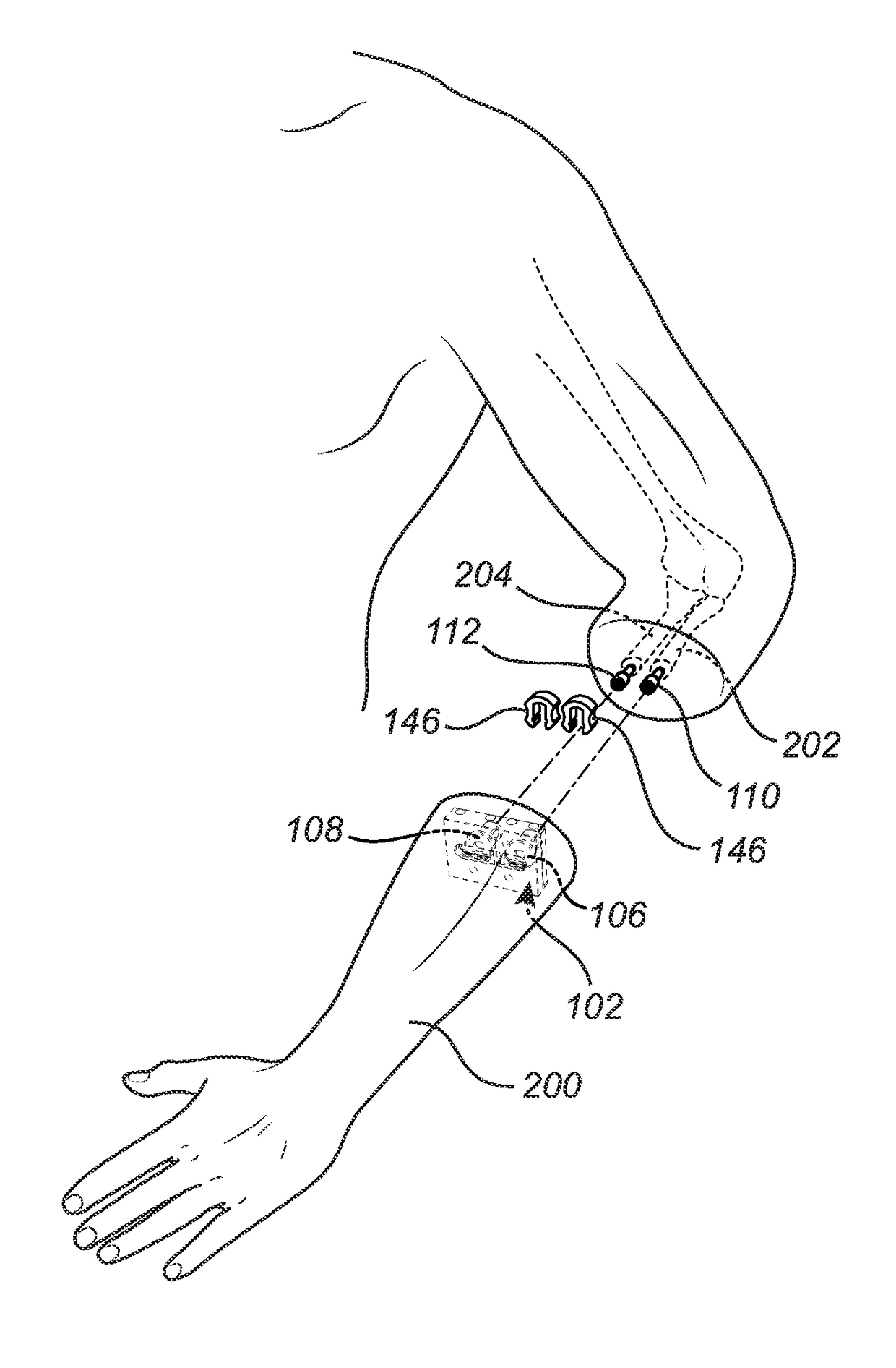 Attachment device allowing natural wrist rotation for osseointegrated prostheses
