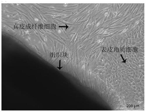 Method for constructing human dermal fibroblast in-vitro thermal damage model and application of method
