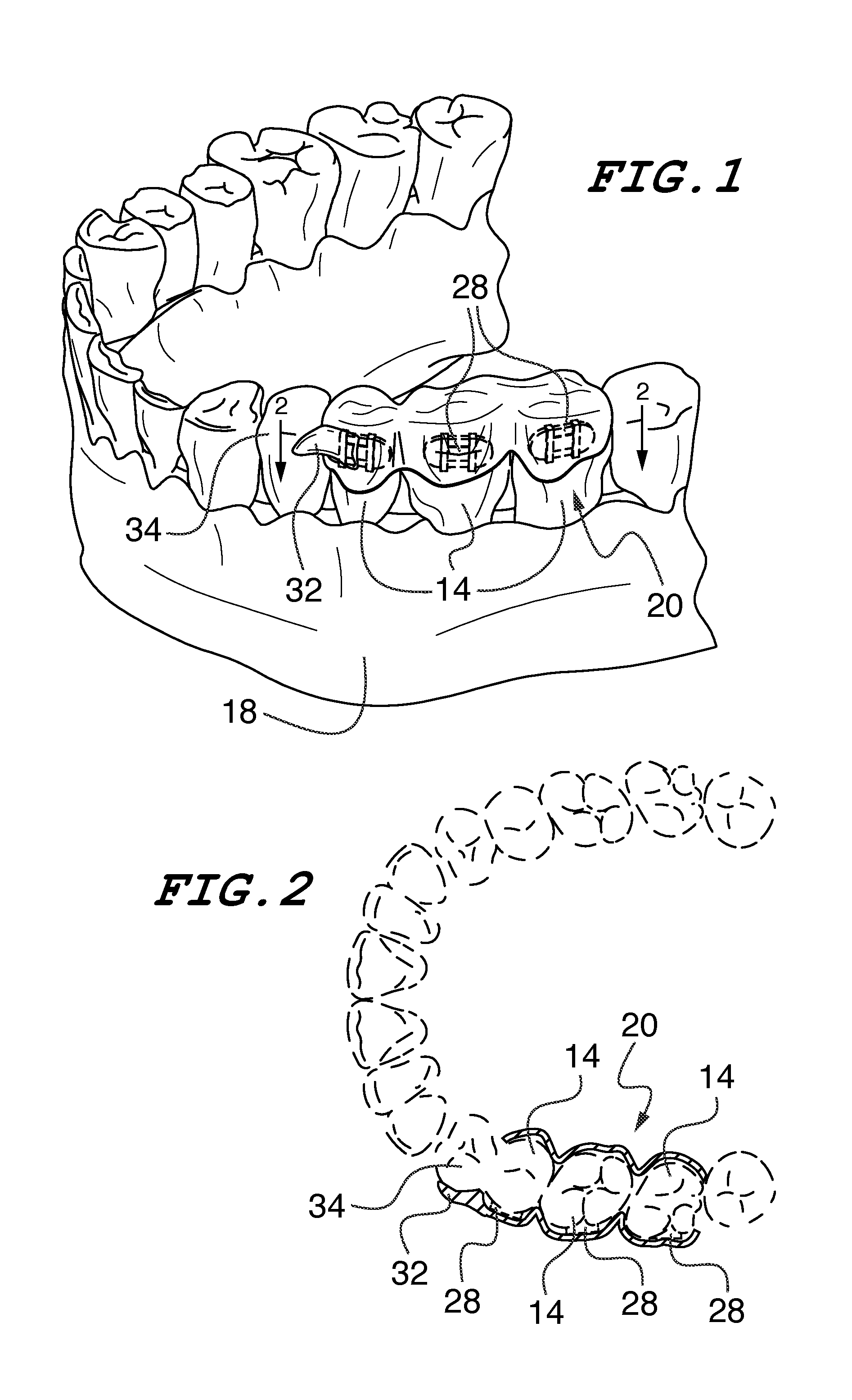 Orthodontic indirect bonding tray including stabilization features