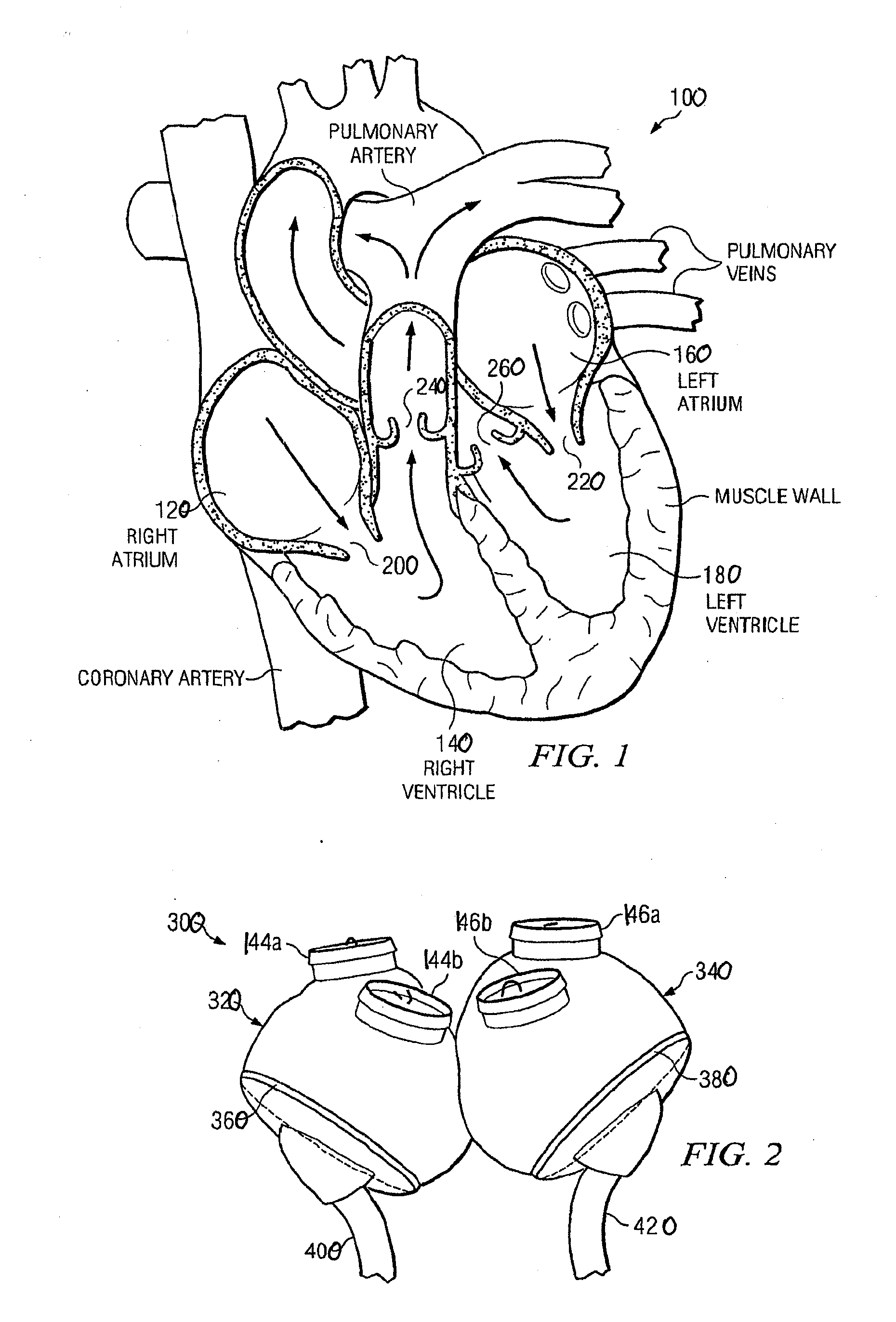 Artificial heart