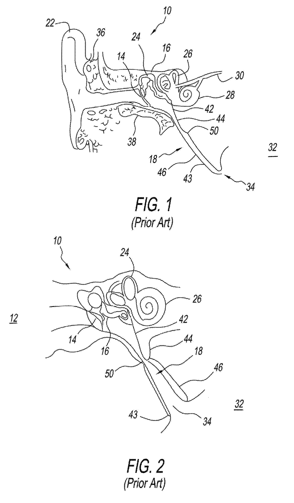 Method and apparatus for treating a malformed eustachian tube