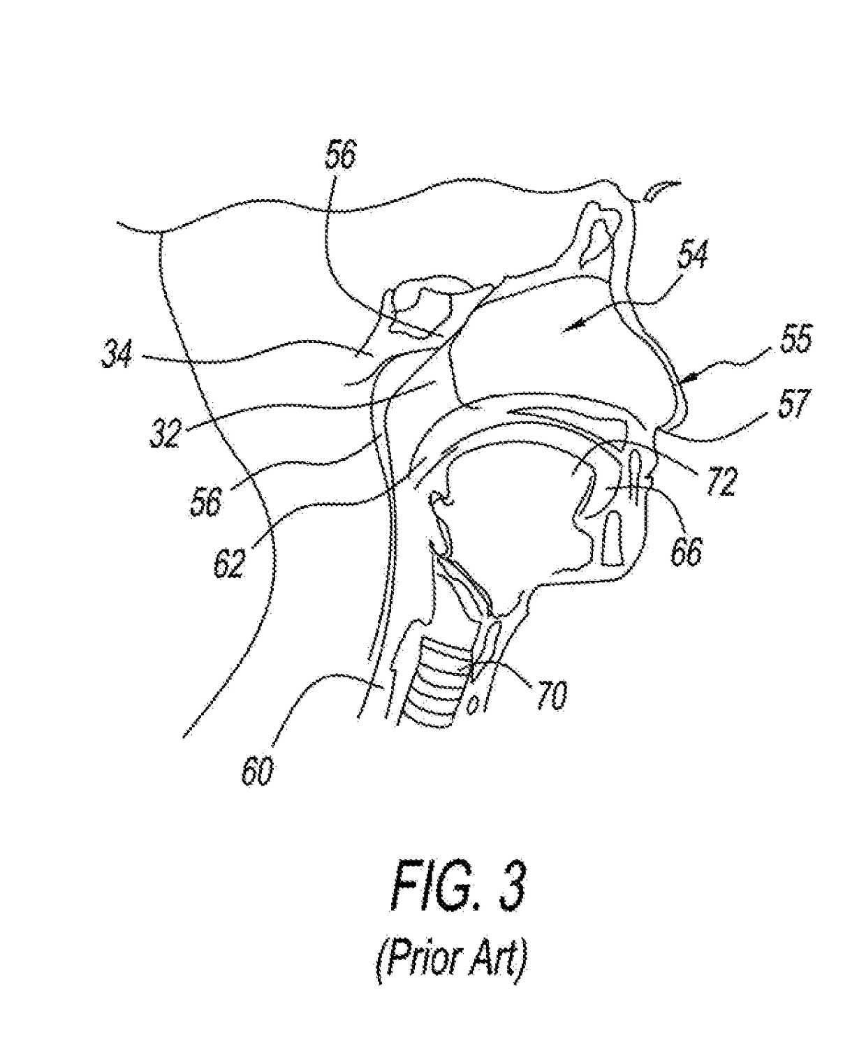 Method and apparatus for treating a malformed eustachian tube
