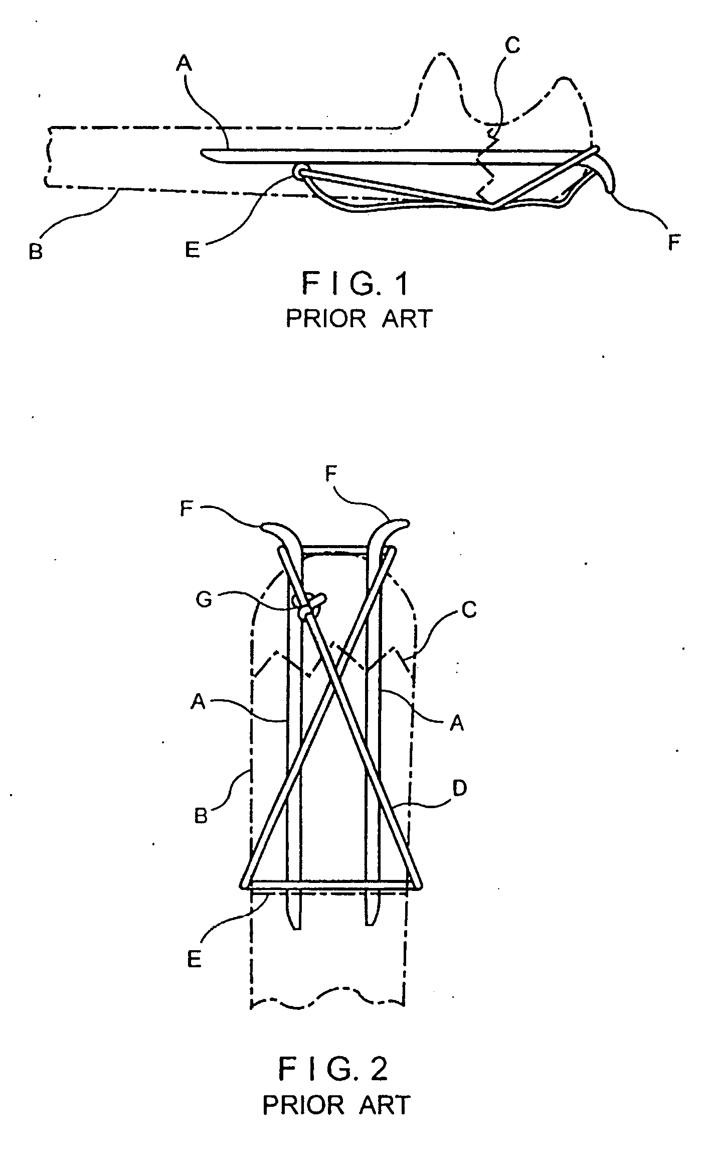 Implant device for applying compression across a fracture site