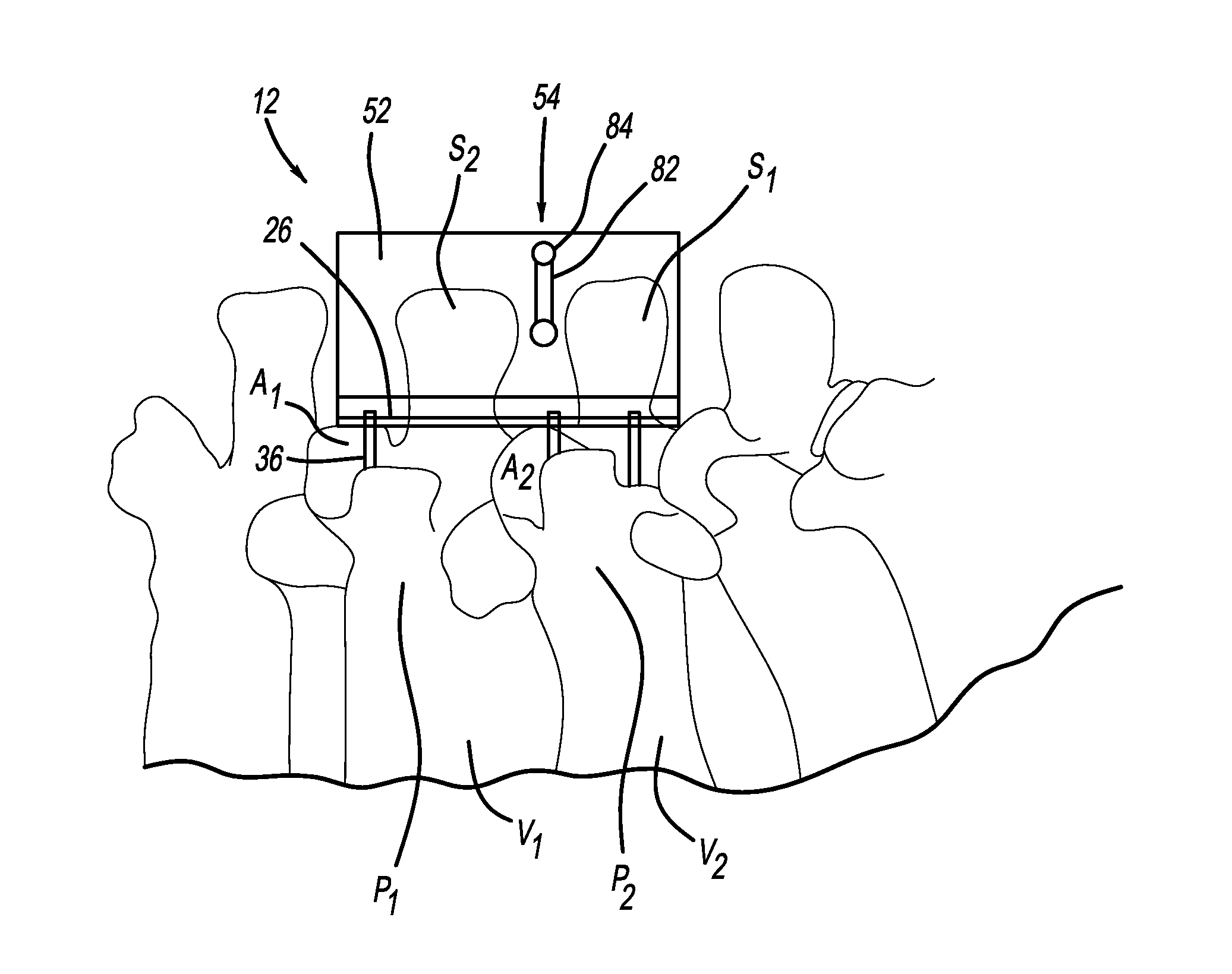 Intra spinous process and method of bone graft placement