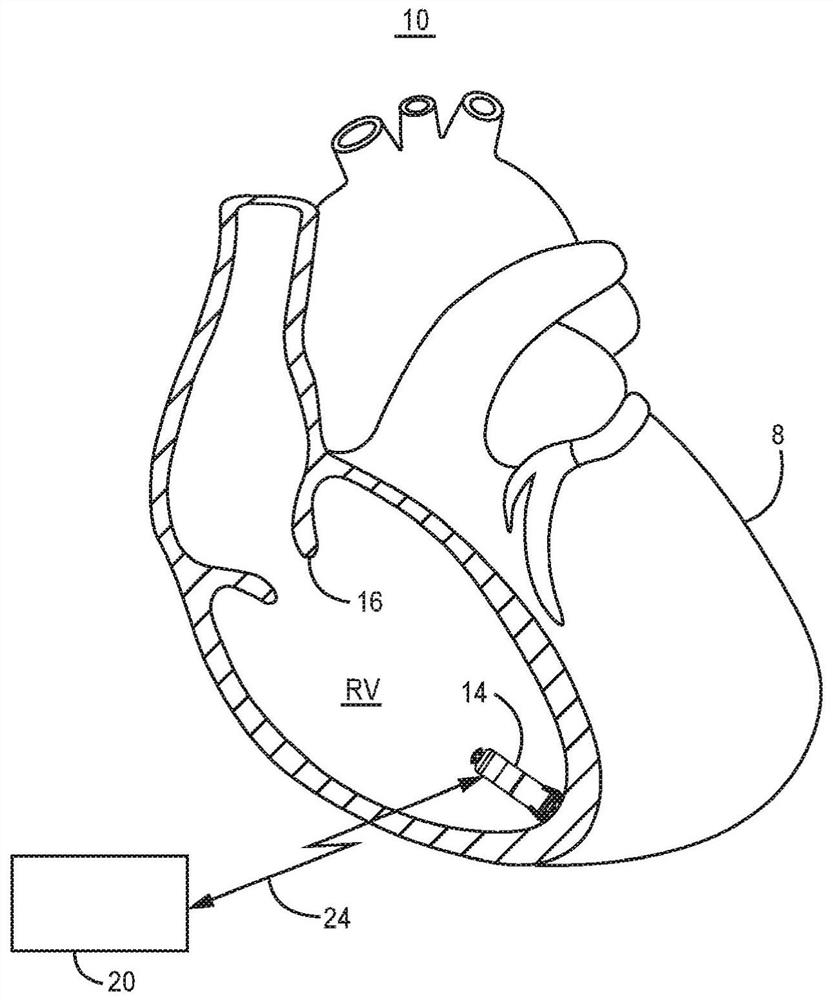 Rate smoothing to enhance atrial synchronous pacing in a ventricular ...