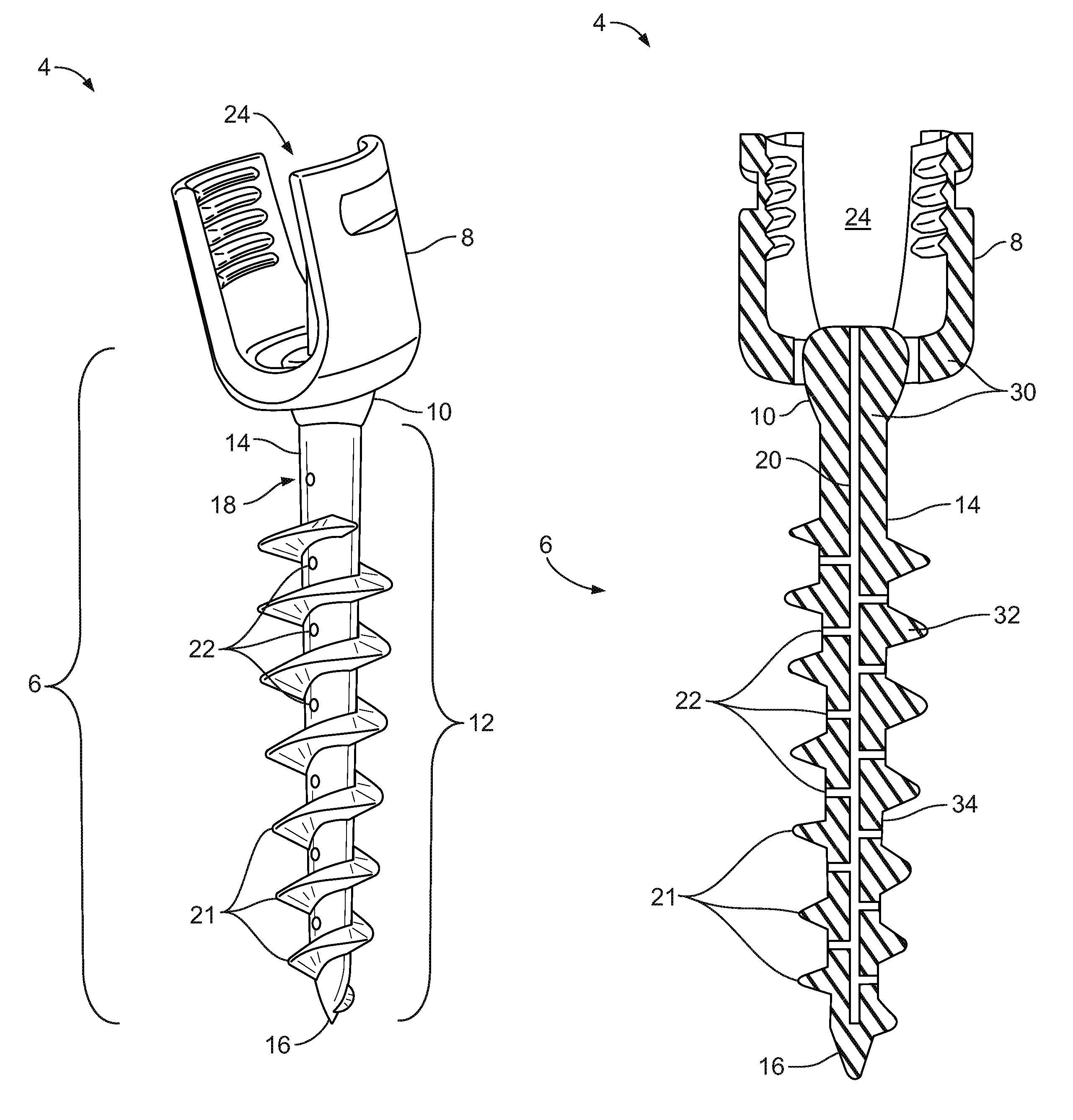 Composite metal and bone orthopedic fixation devices