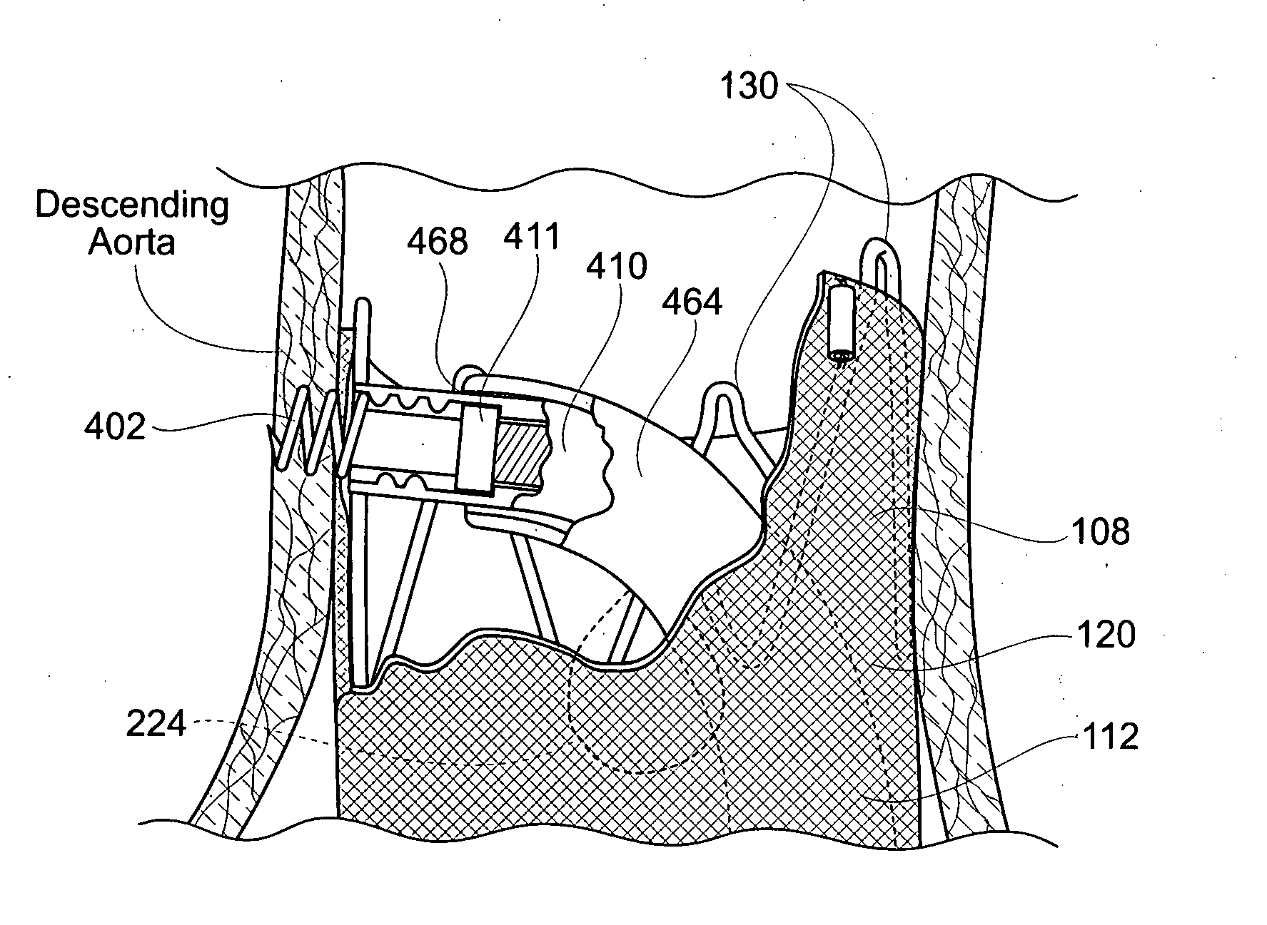 Devices, systems, and methods for prosthesis delivery and implantation, including the use of a fastener tool