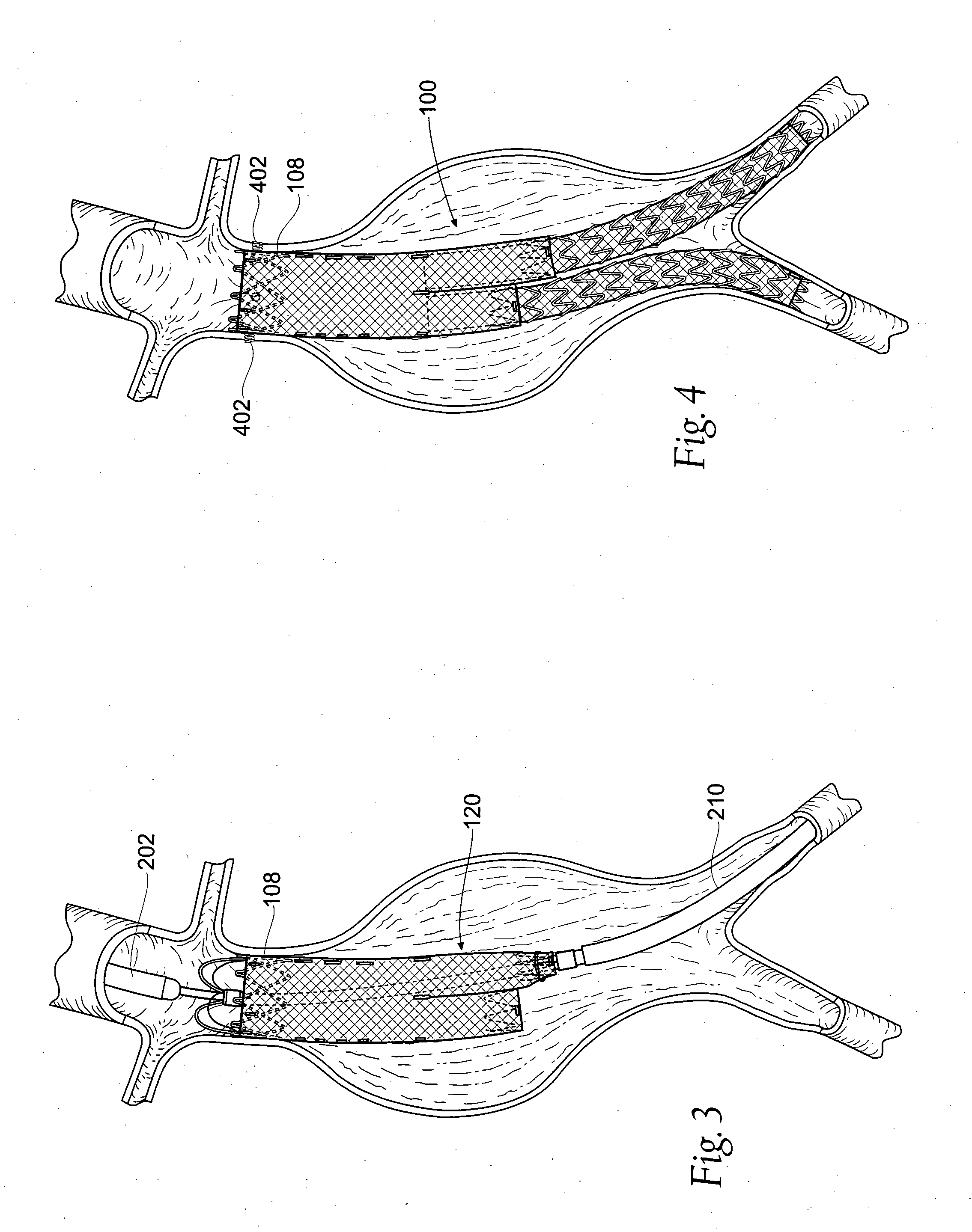 Devices, systems, and methods for prosthesis delivery and implantation, including the use of a fastener tool