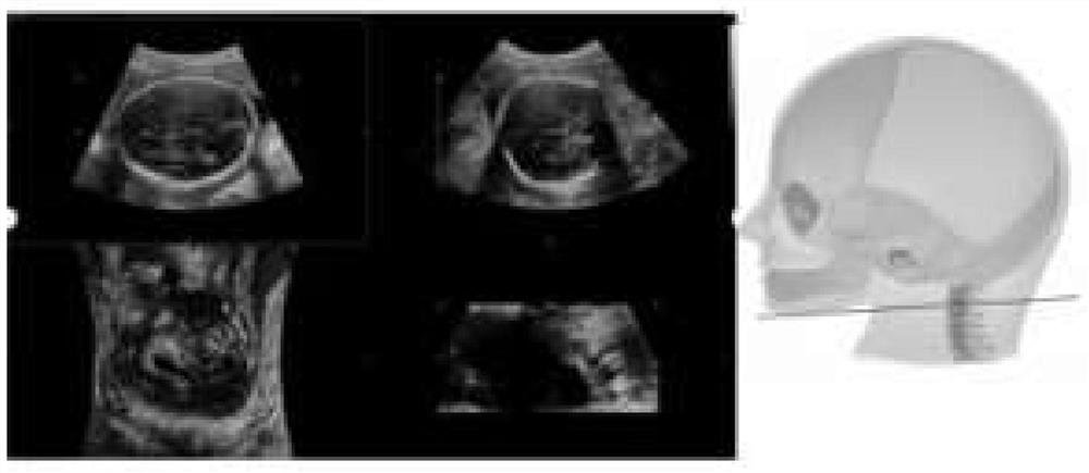 Method and system for imaging fetal brain channeling three-dimensional image in ultrasonic image