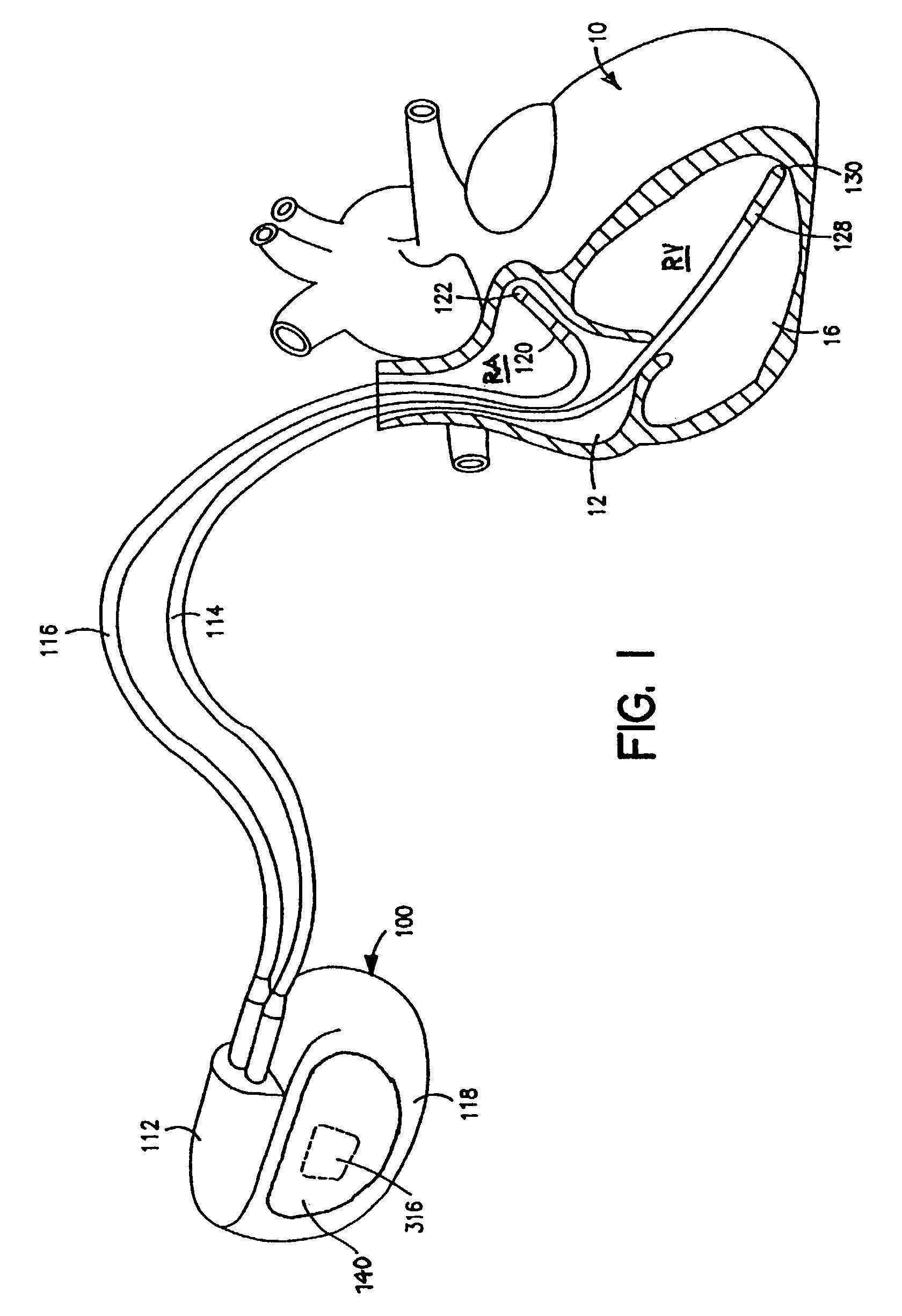 Methods and apparatus for detecting ventricular depolarizations during atrial pacing