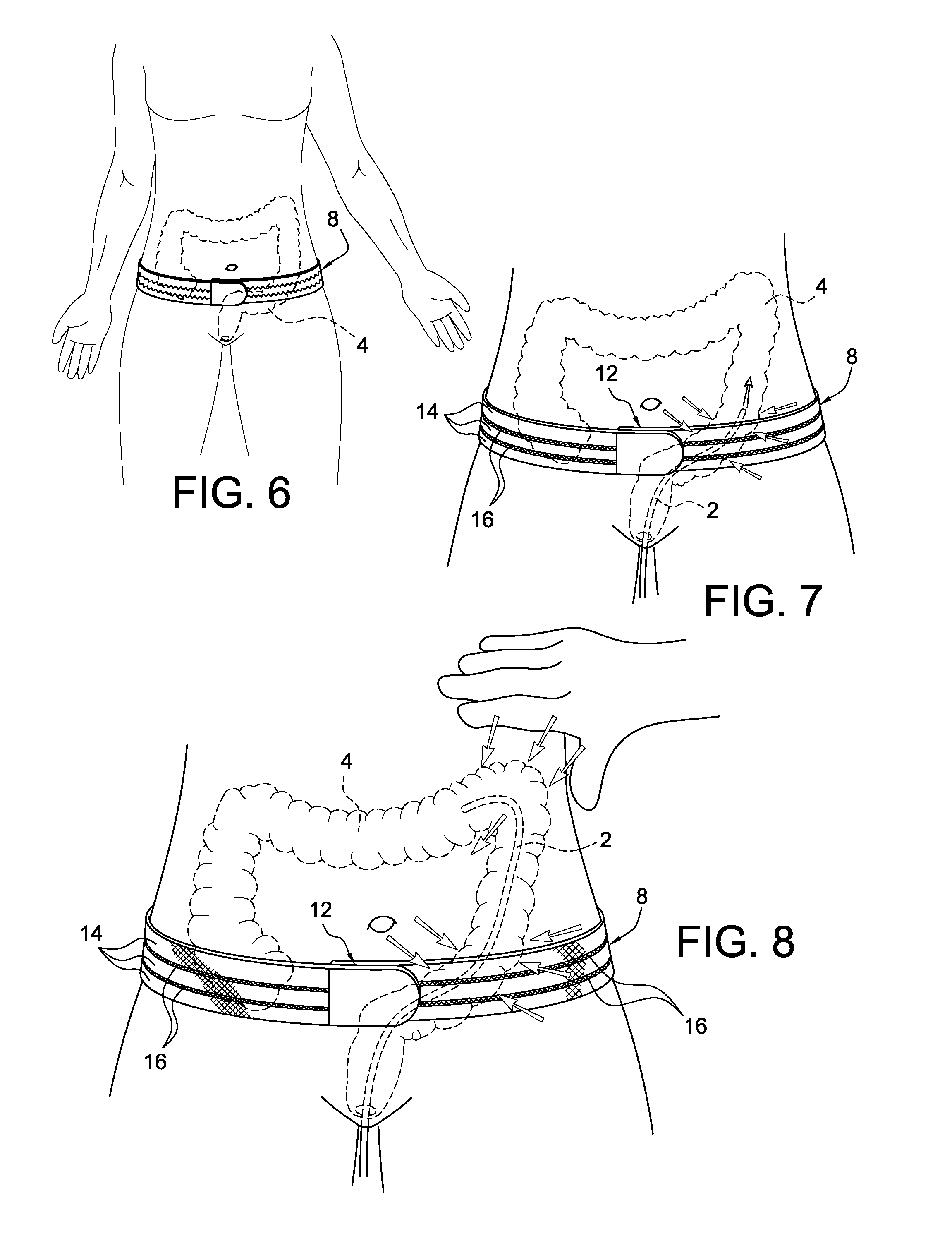 Method and apparatus for tensile colonoscopy compression