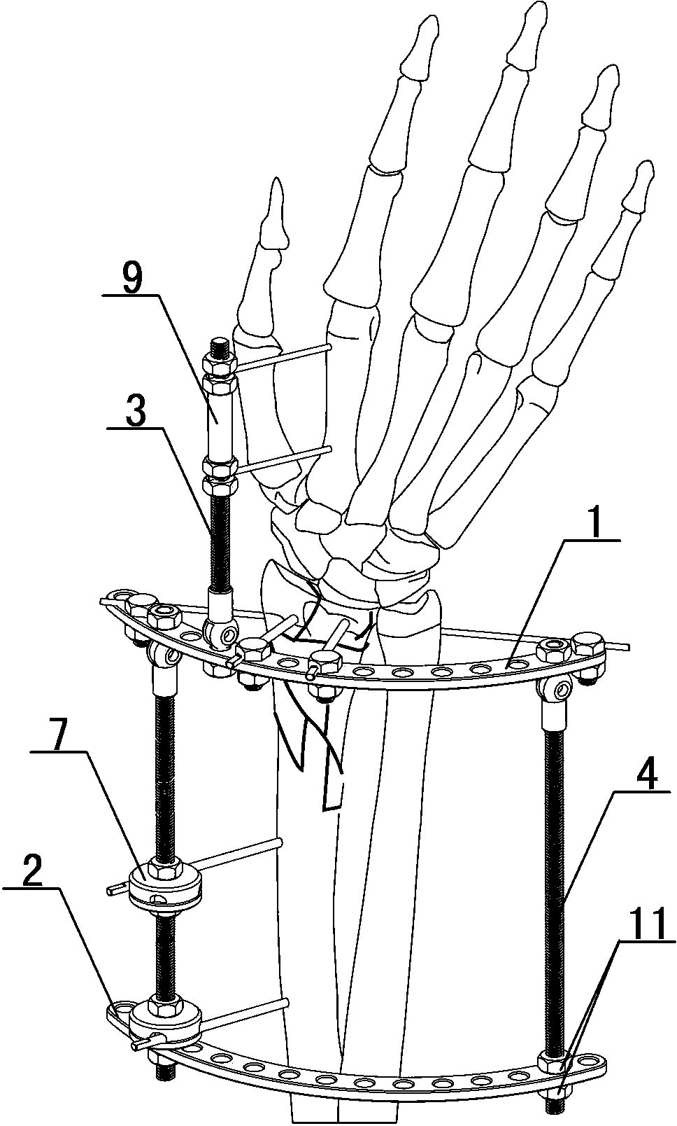 Activity-inertia combined adjusting control outer fixer for distal radius fracture