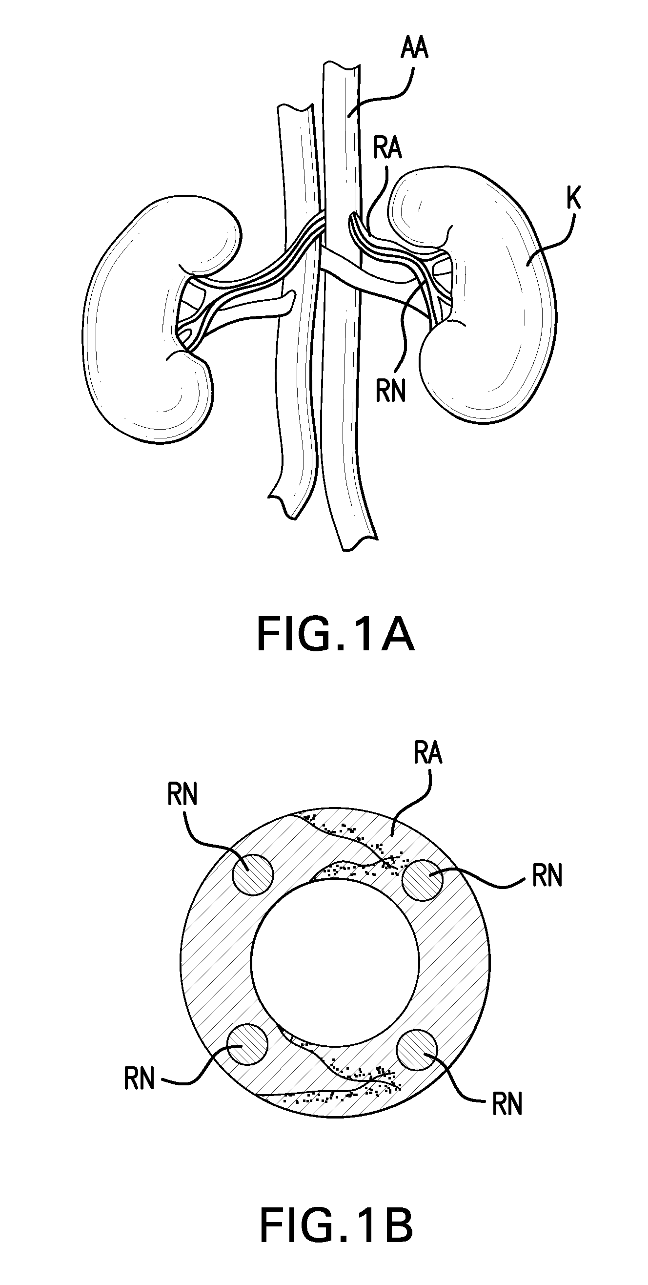 Methods and devices for denervation