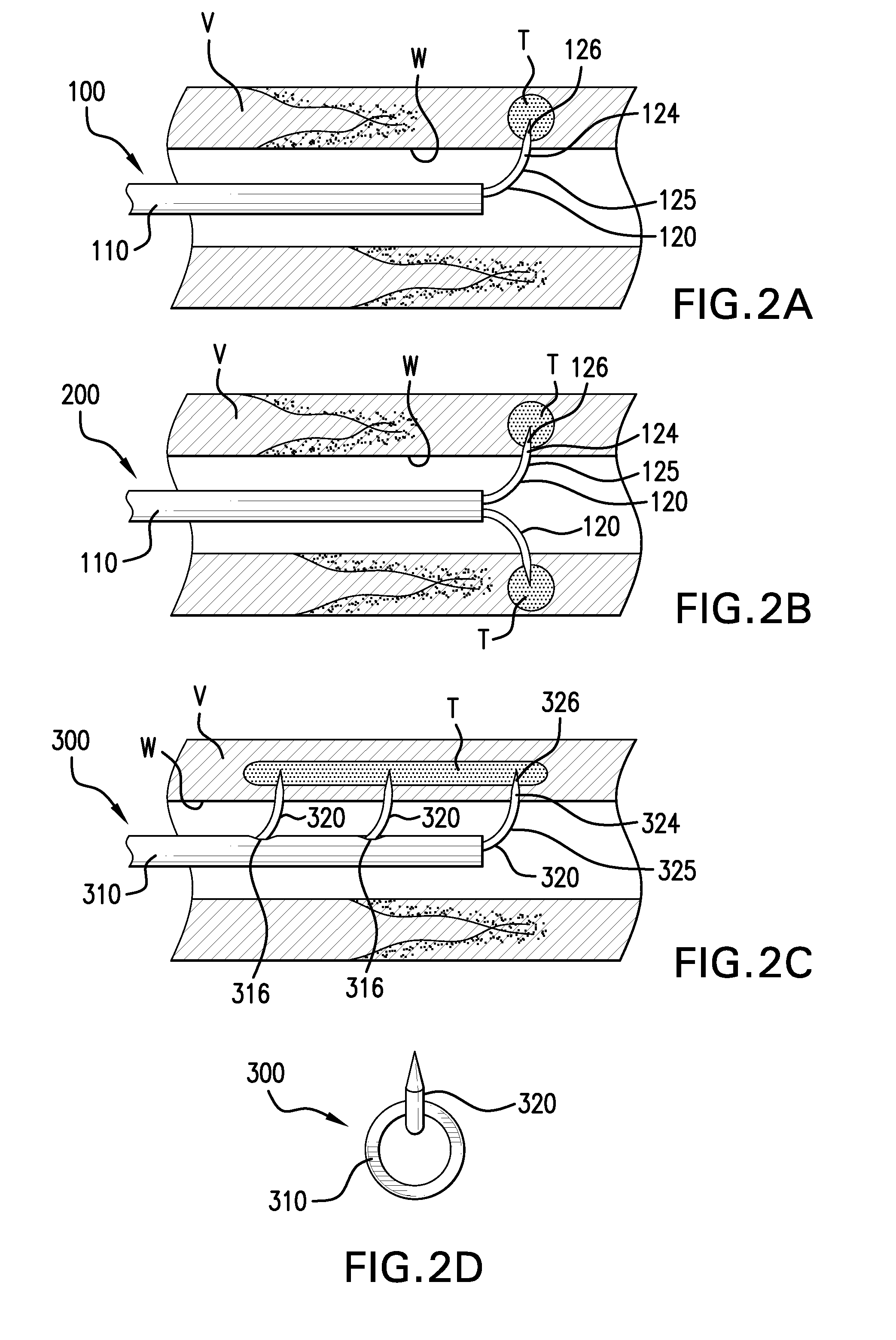 Methods and devices for denervation