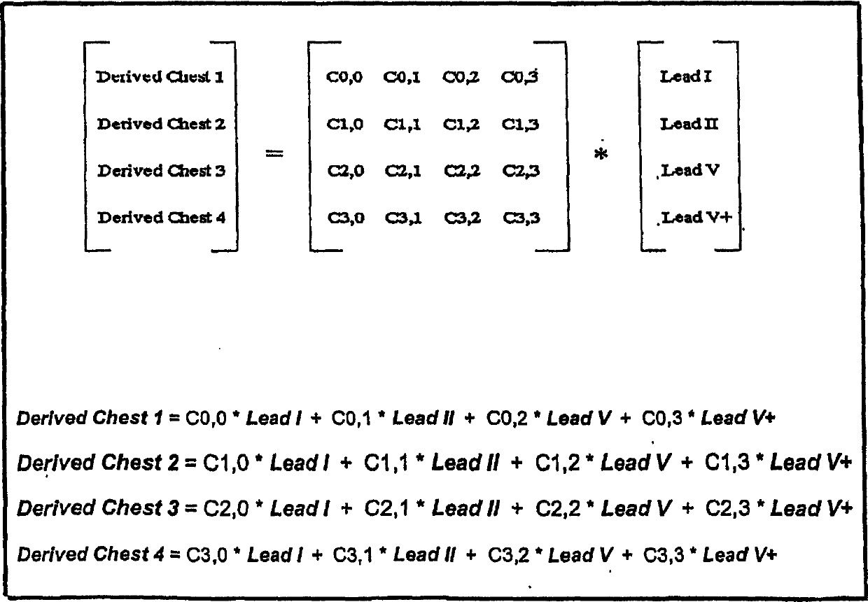 System for adaptively deriving ECG chest lead signal data