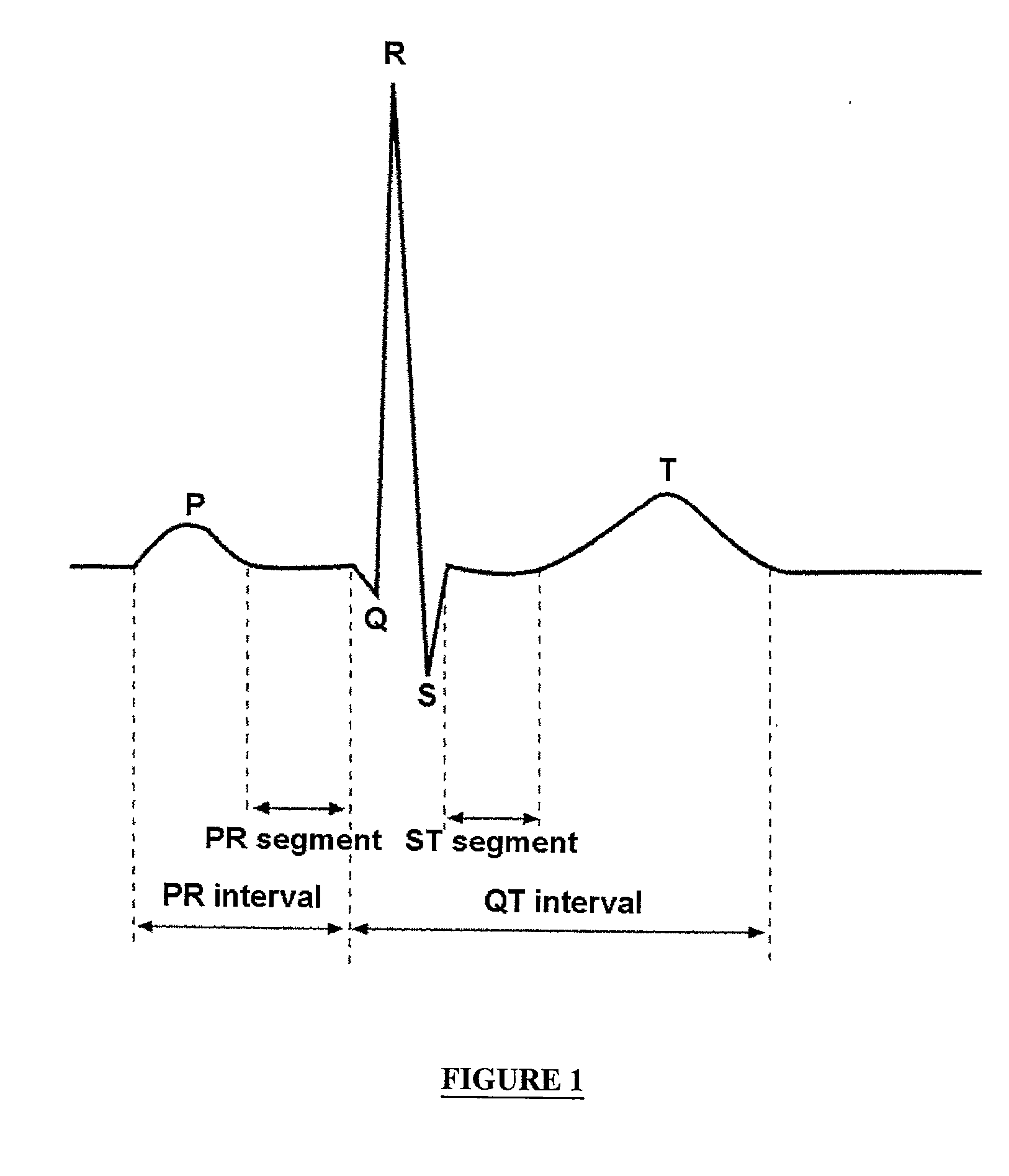 Apparatus for detecting sleep apnea using electrocardiogram signals