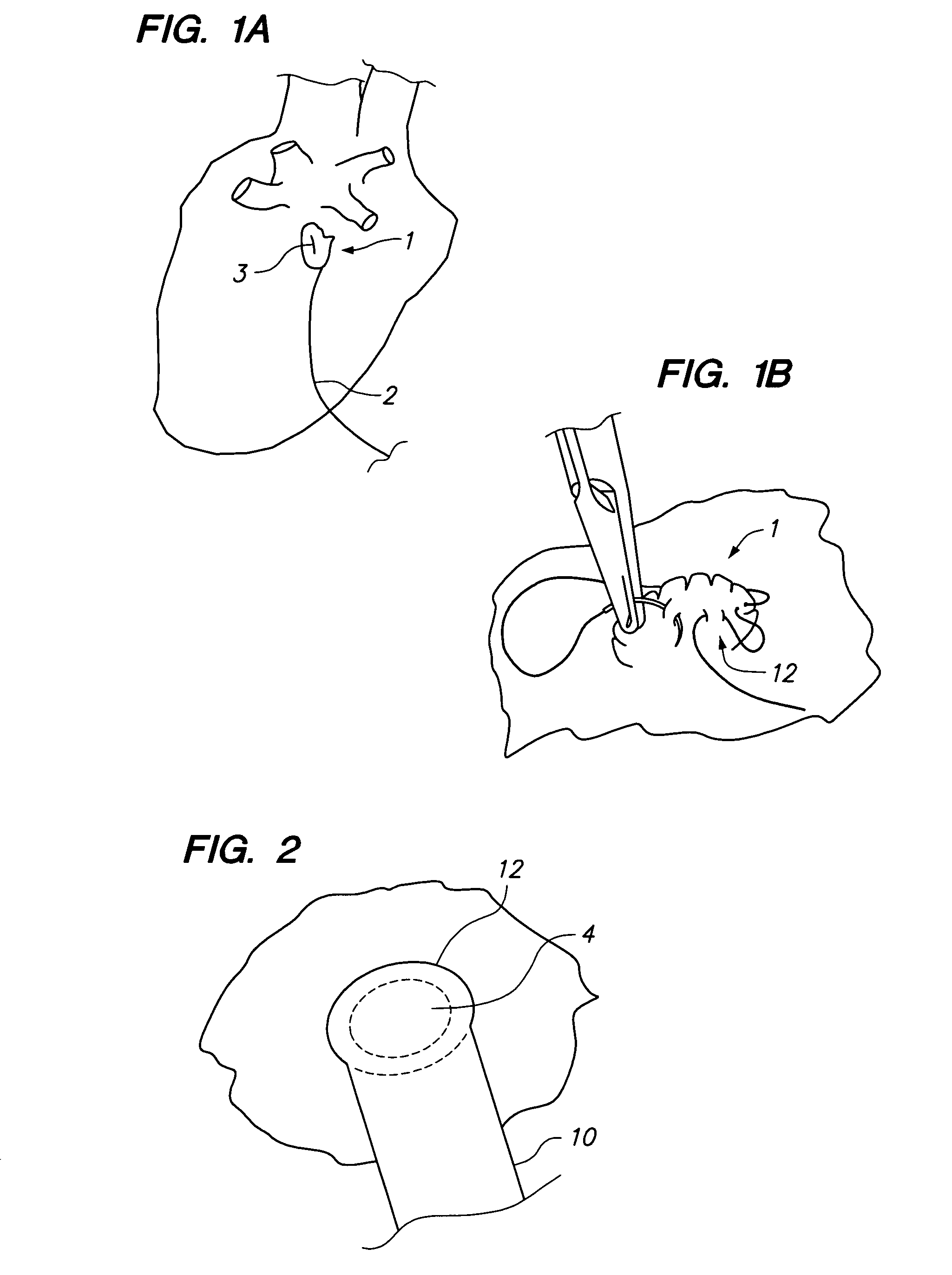 Ablation instruments and methods for performing abalation