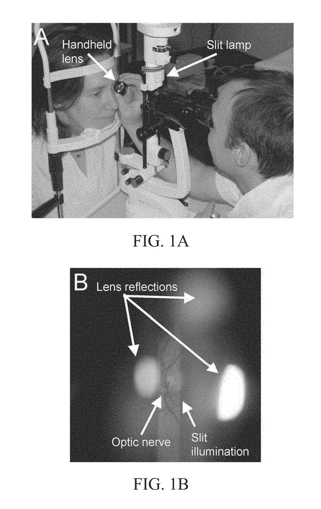 Self-illuminated handheld lens for retinal examination and photography and related method thereof