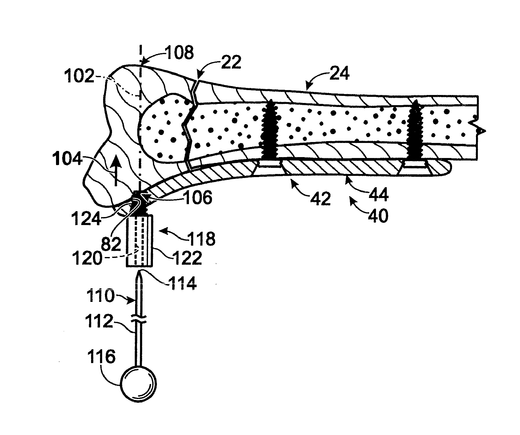 Bone fixation with a bone plate attached to a fastener assembly