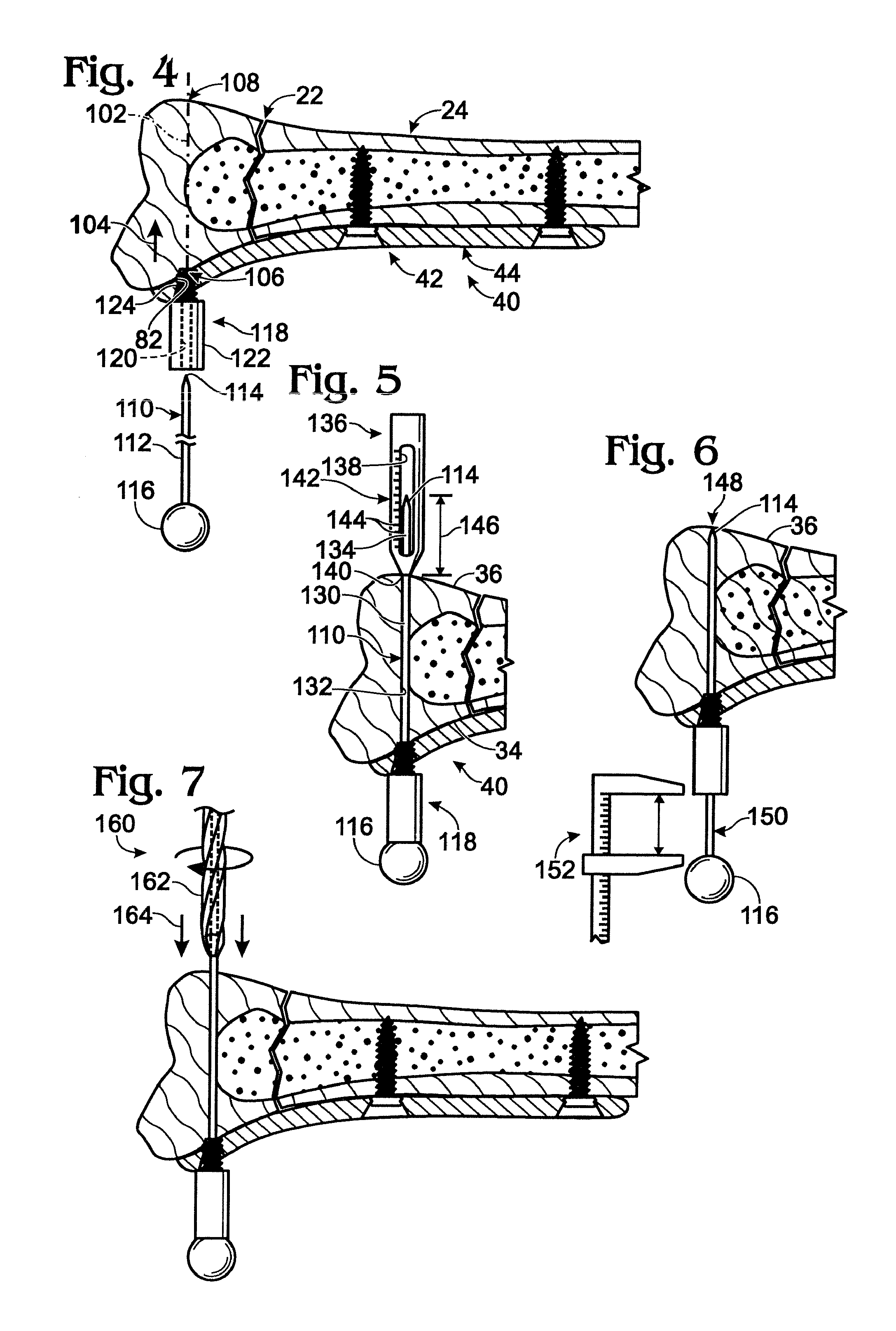 Bone fixation with a bone plate attached to a fastener assembly