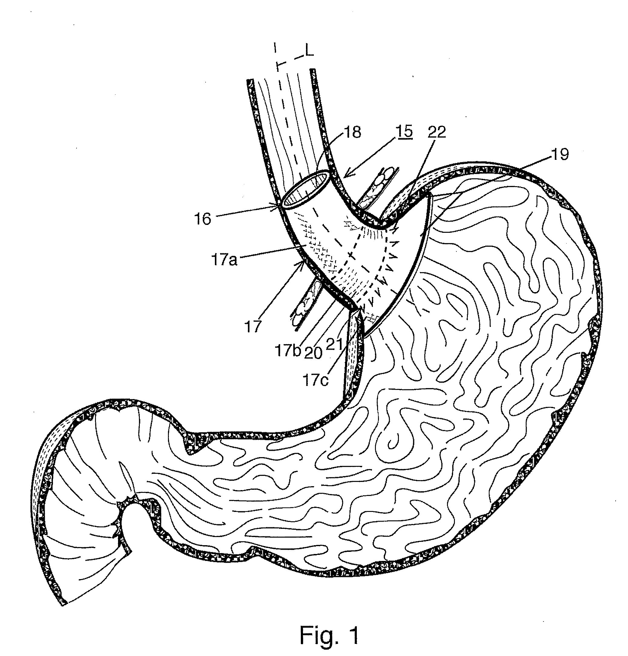 Bariatric device and method