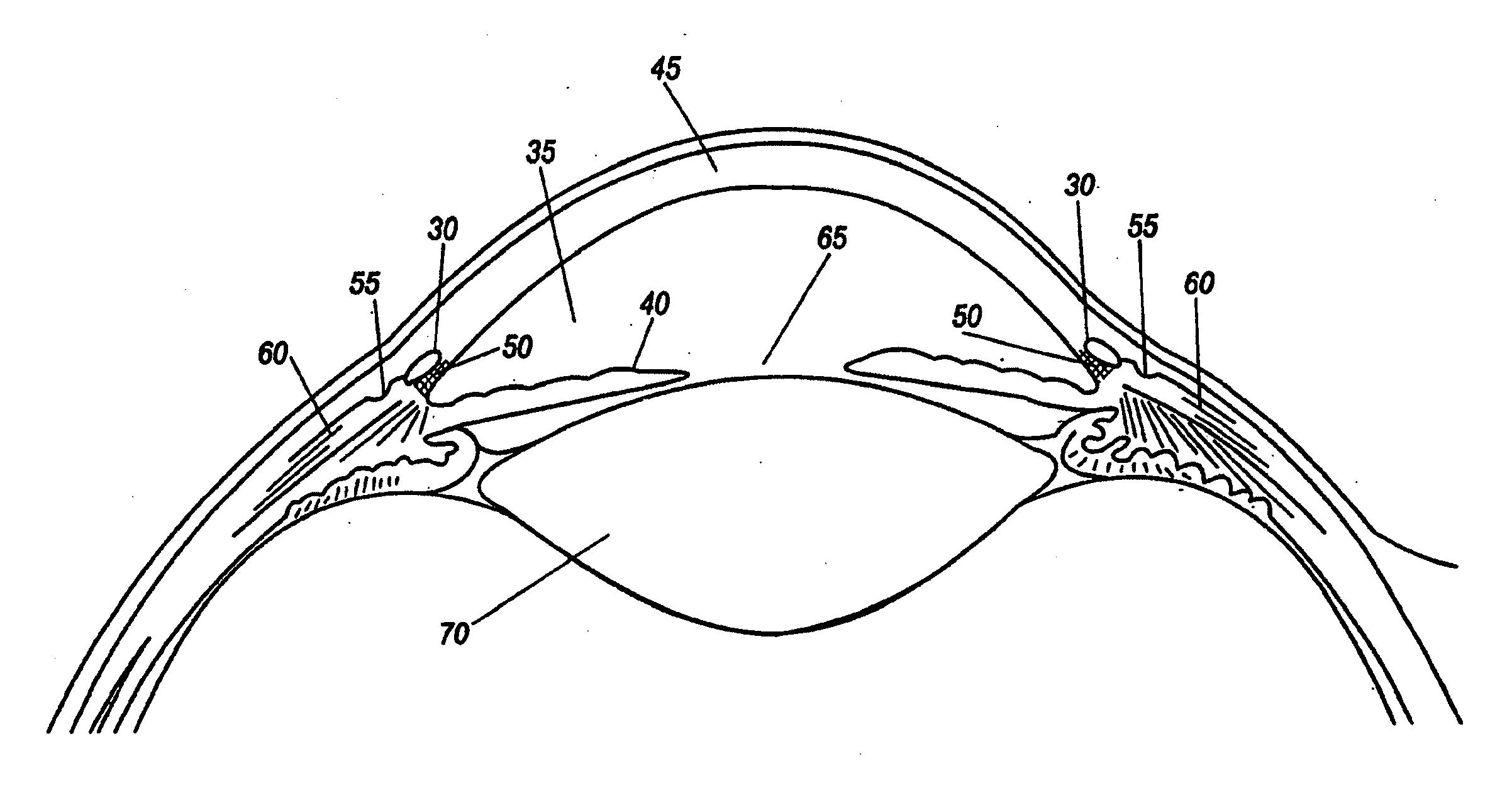 Shunt device and method for treating ocular disorders