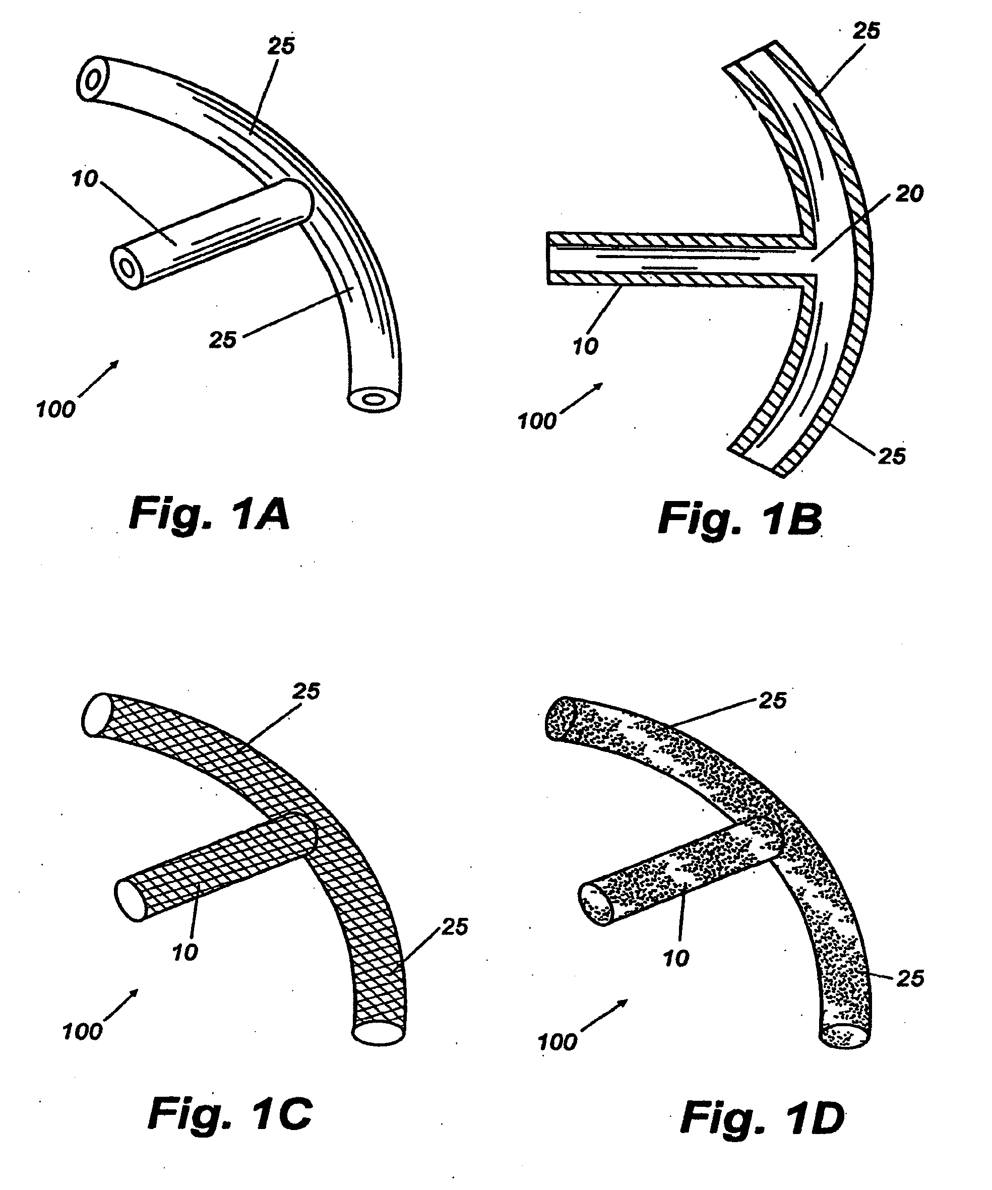Shunt device and method for treating ocular disorders