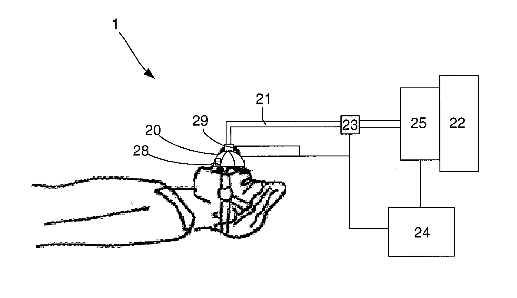 System and Method for Diagnosis and Treatment of Obstructive Sleep Apnea