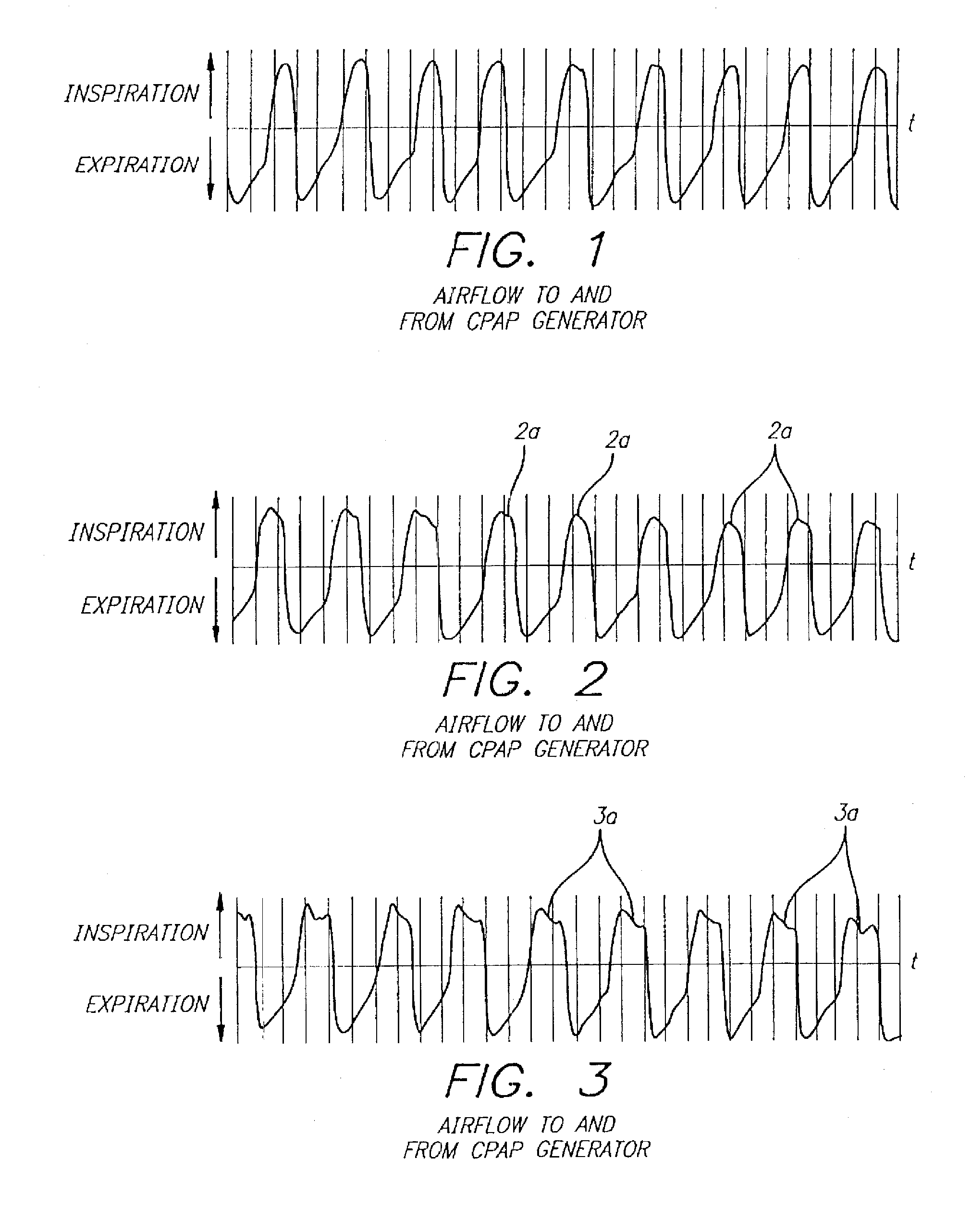 System and Method for Diagnosis and Treatment of Obstructive Sleep Apnea