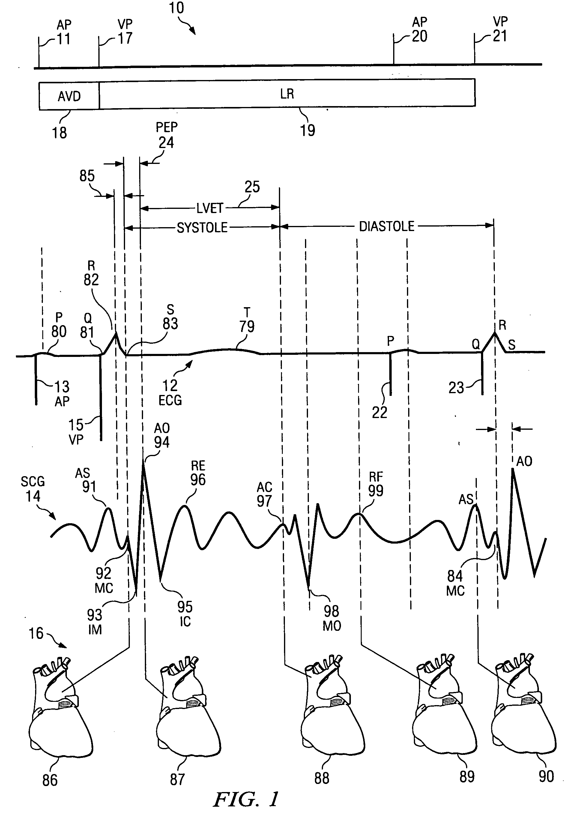 Accelerometer-based method for cardiac function and therapy assessment