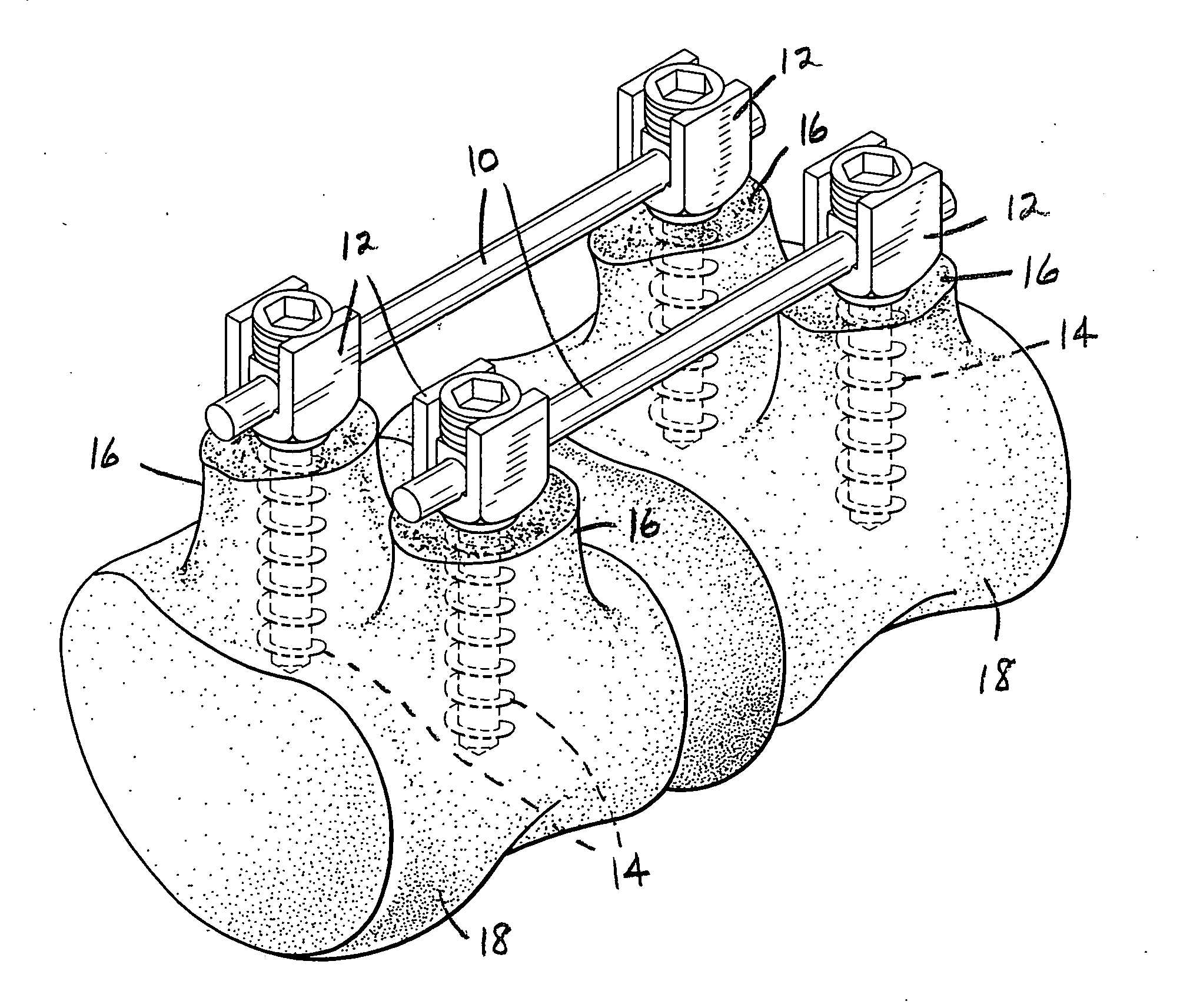 Apparatus and method for flexible spinal fixation