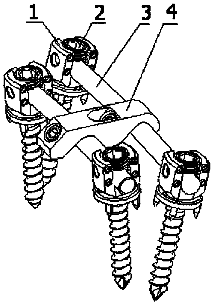 Vertebral pedicle screw and thoracolumbar spine anterior internal fixing system
