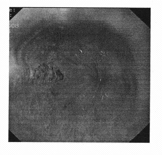 Chinese patent medicine for treating reflux esophagitis and preparation method thereof